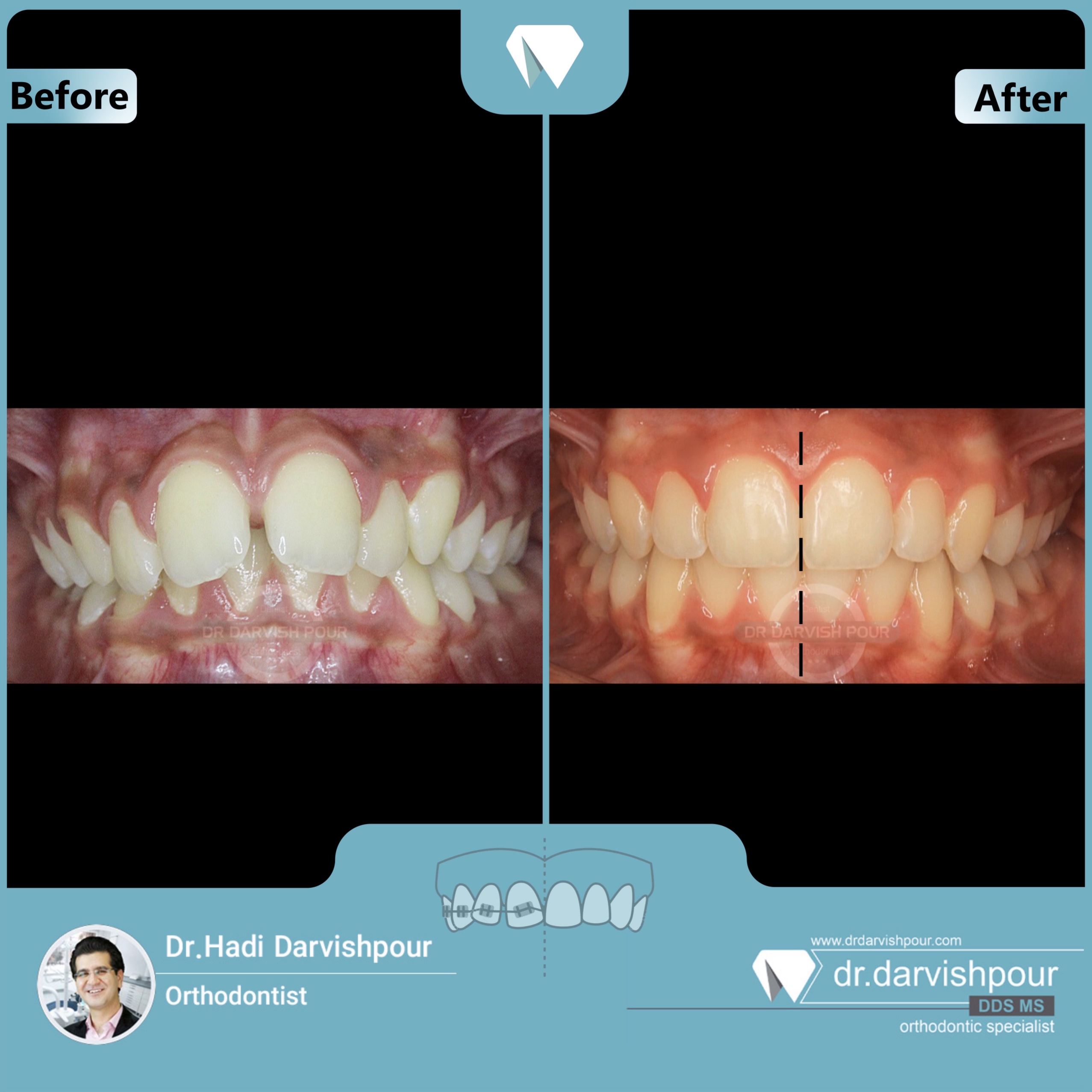 1685orthodontics-before-after-photo