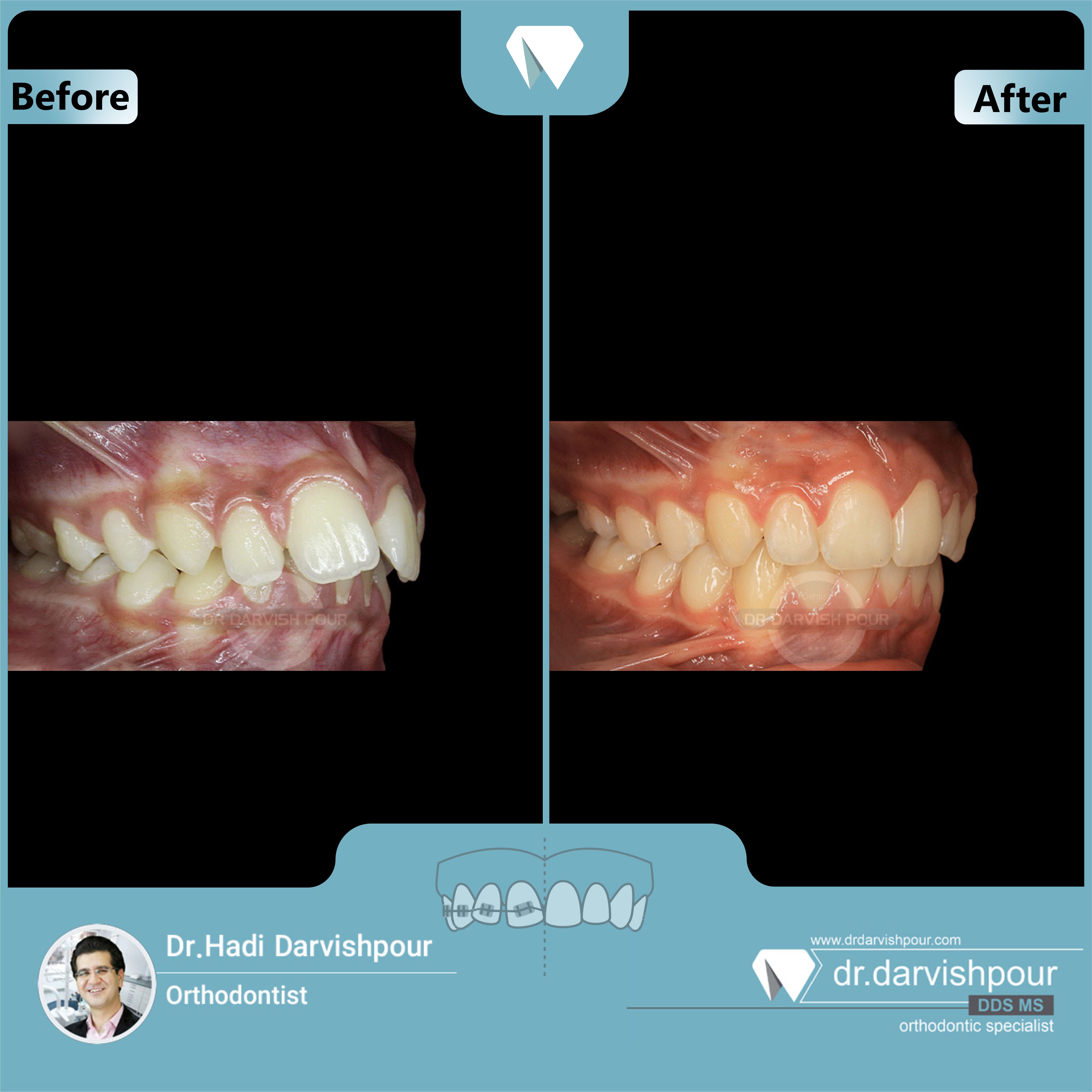 1686orthodontics-before-after-photo