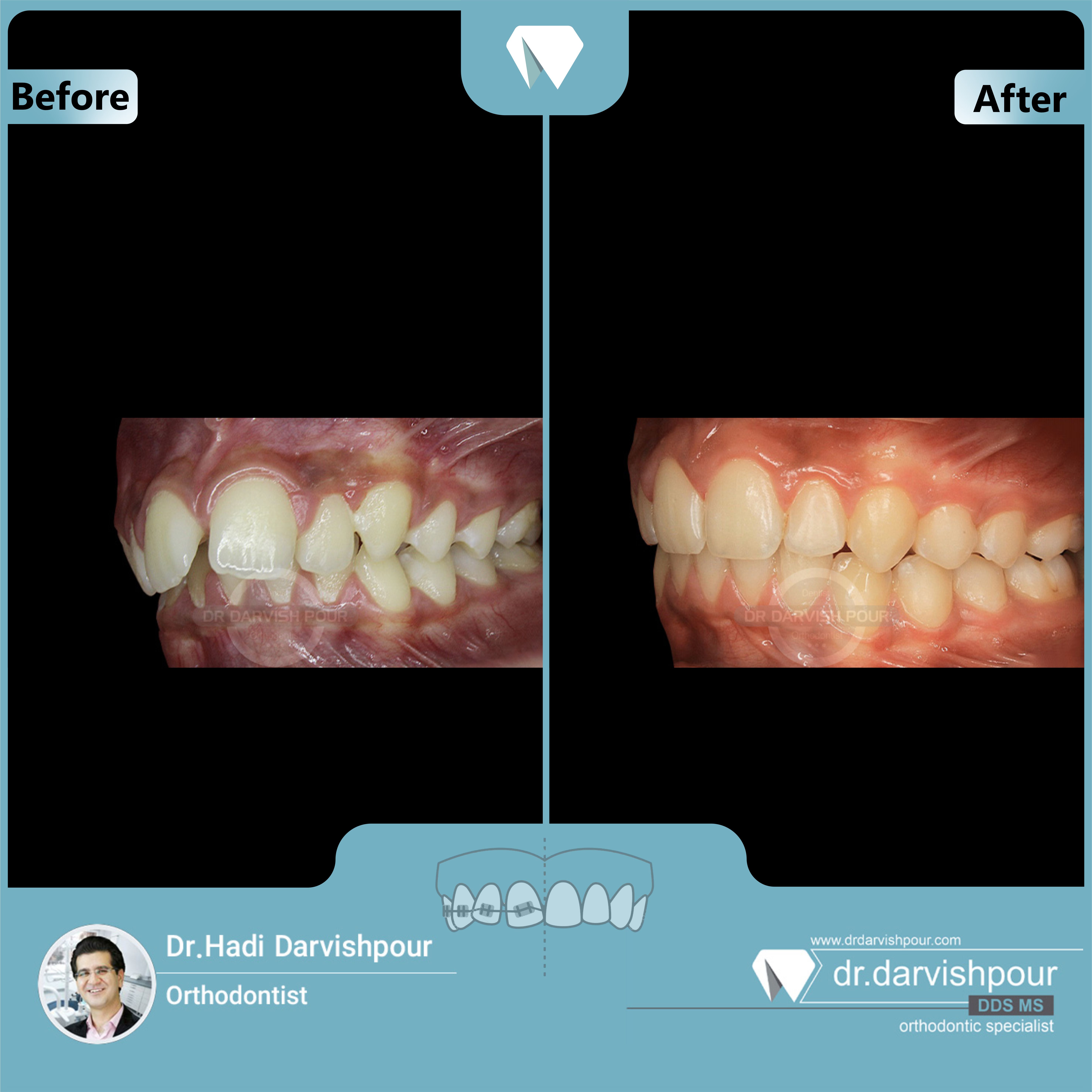 1687orthodontics-before-after-photo