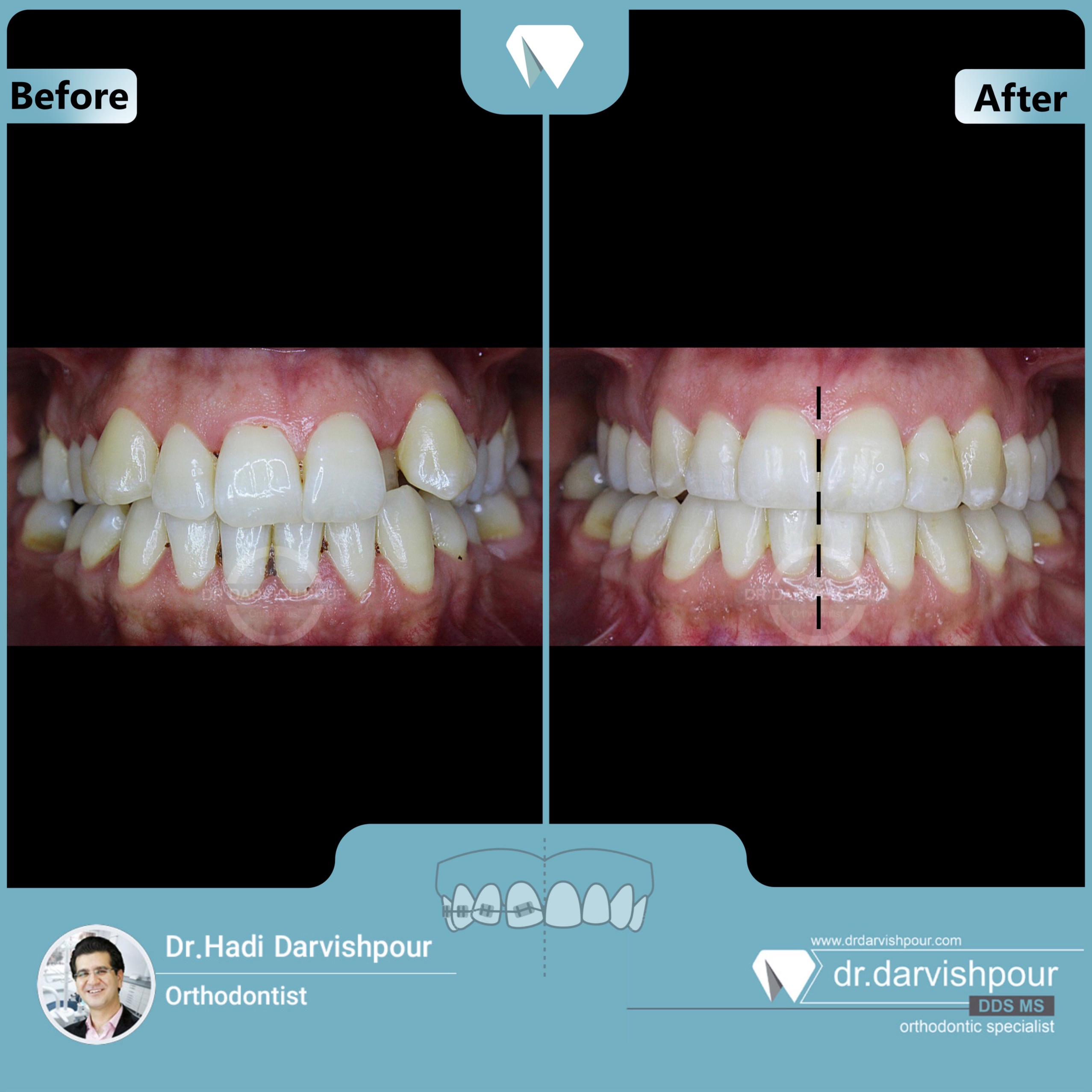 1689orthodontics-before-after-photo