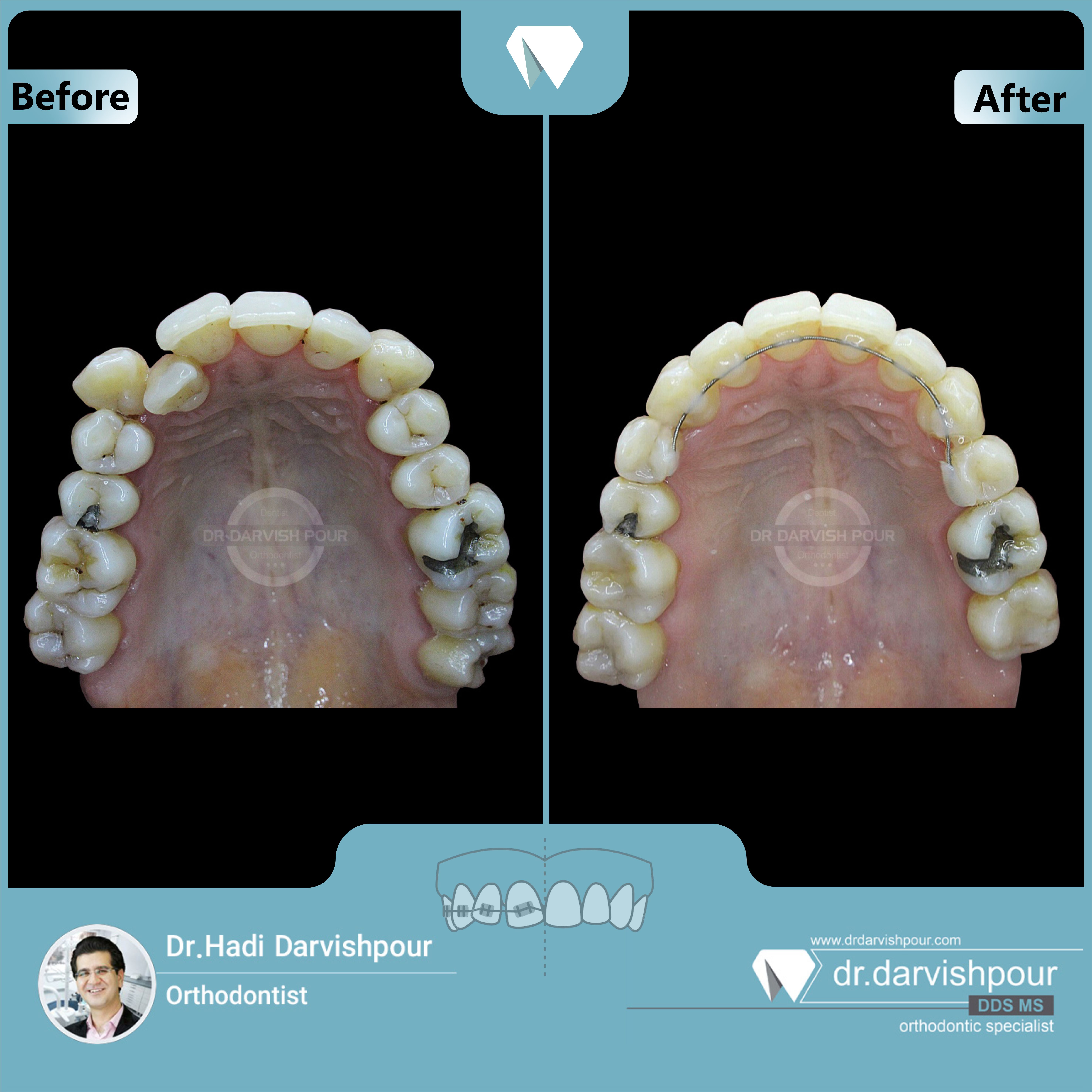 1690orthodontics-before-after-photo