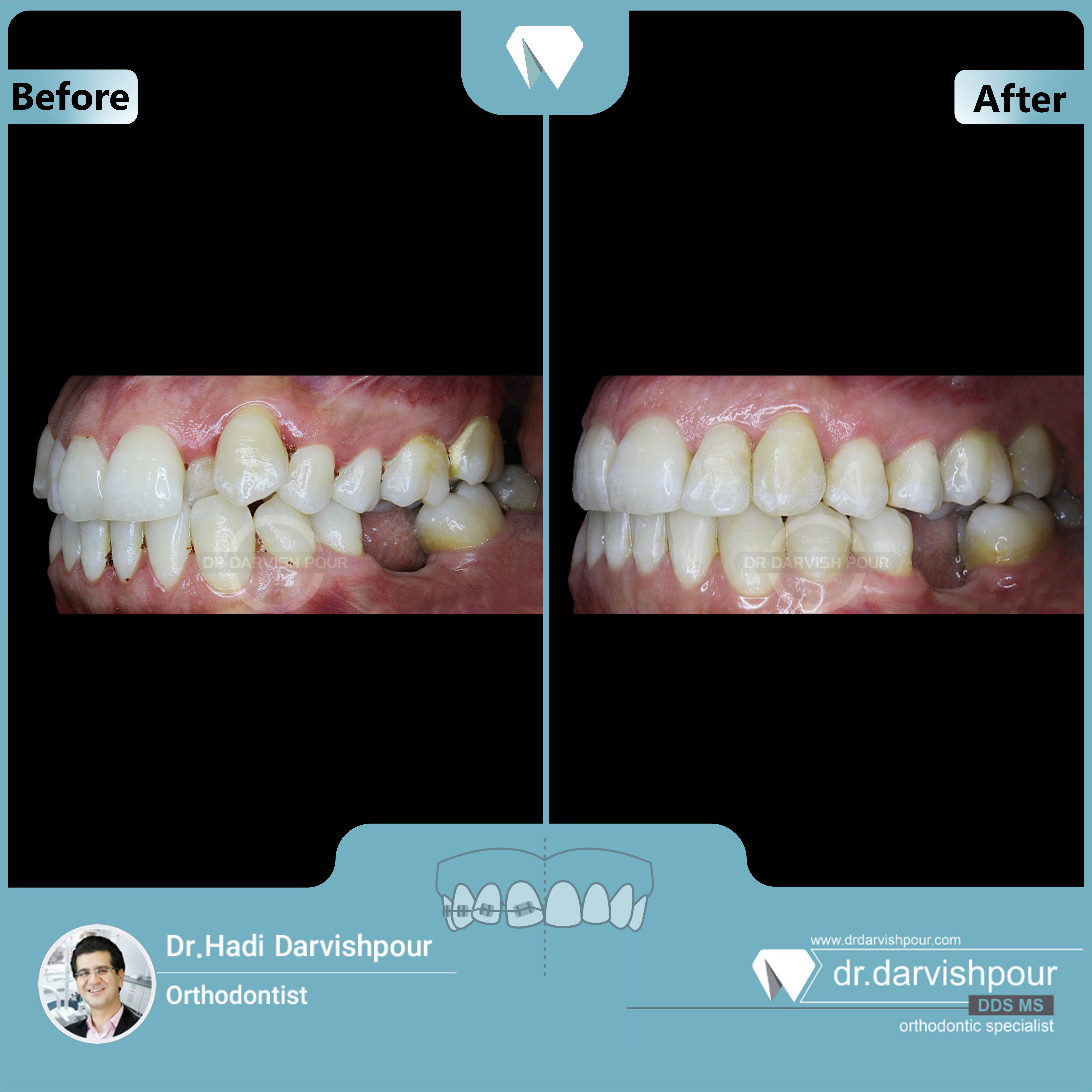 1691orthodontics-before-after-photo