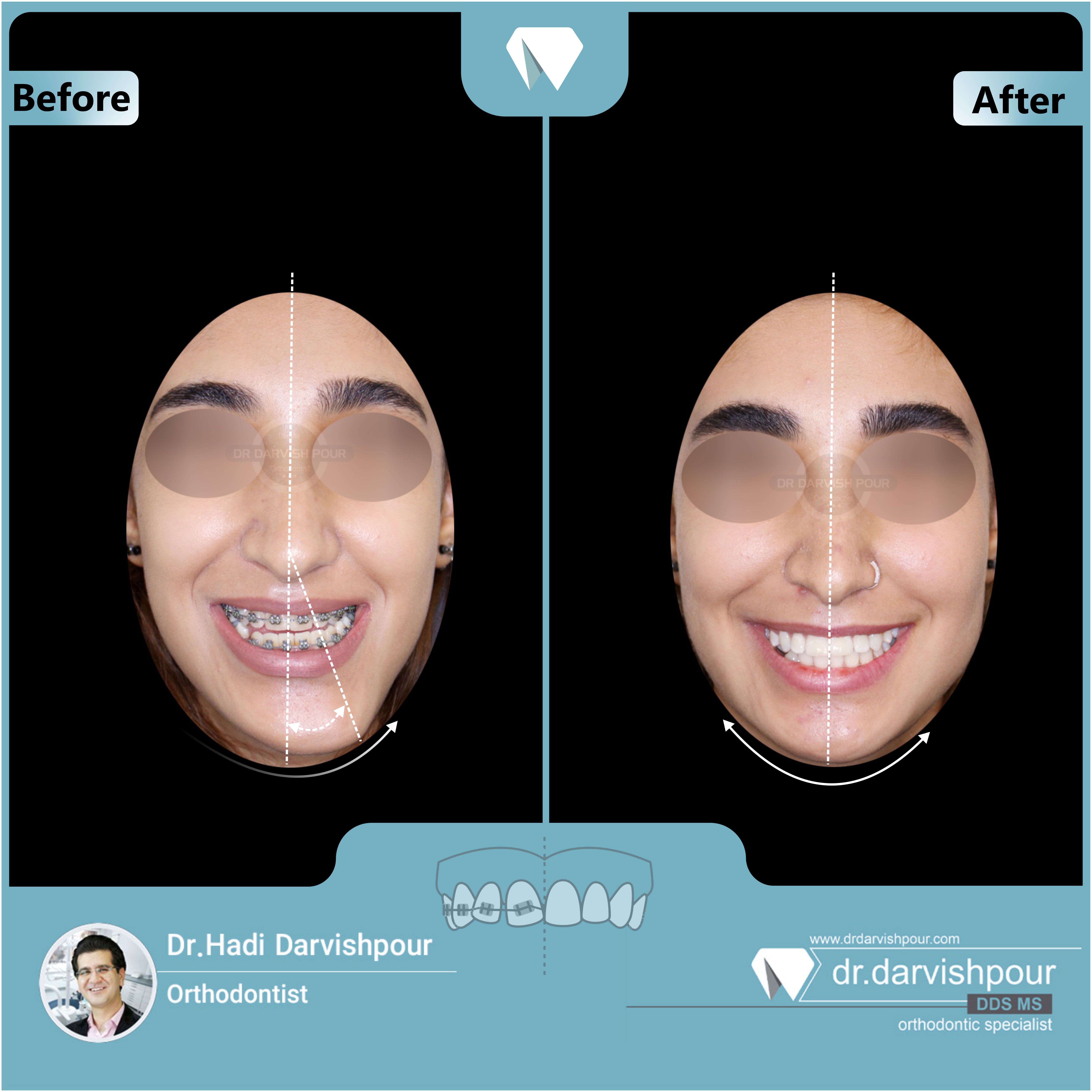 1694orthodontics-before-after-photo