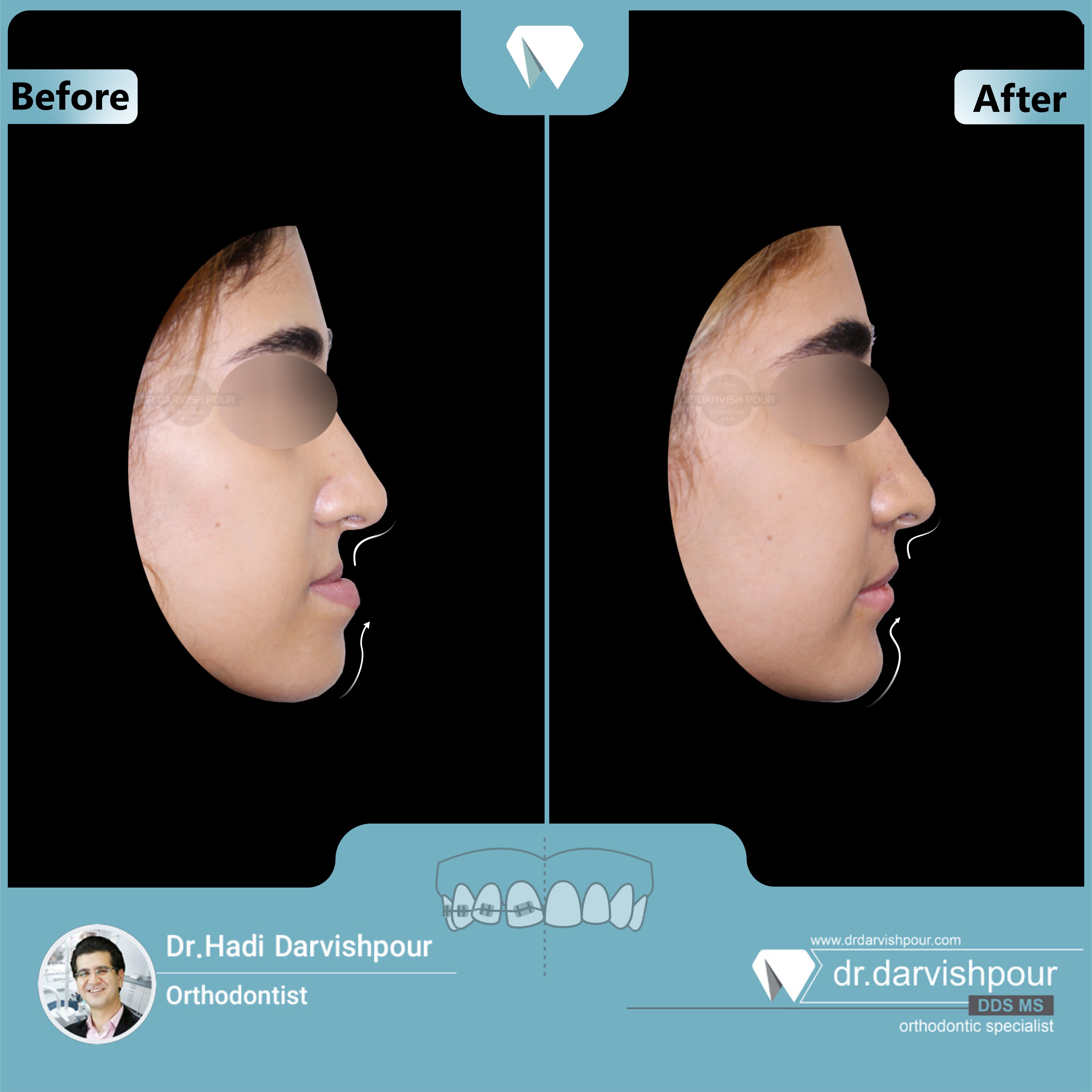 1695orthodontics-before-after-photo
