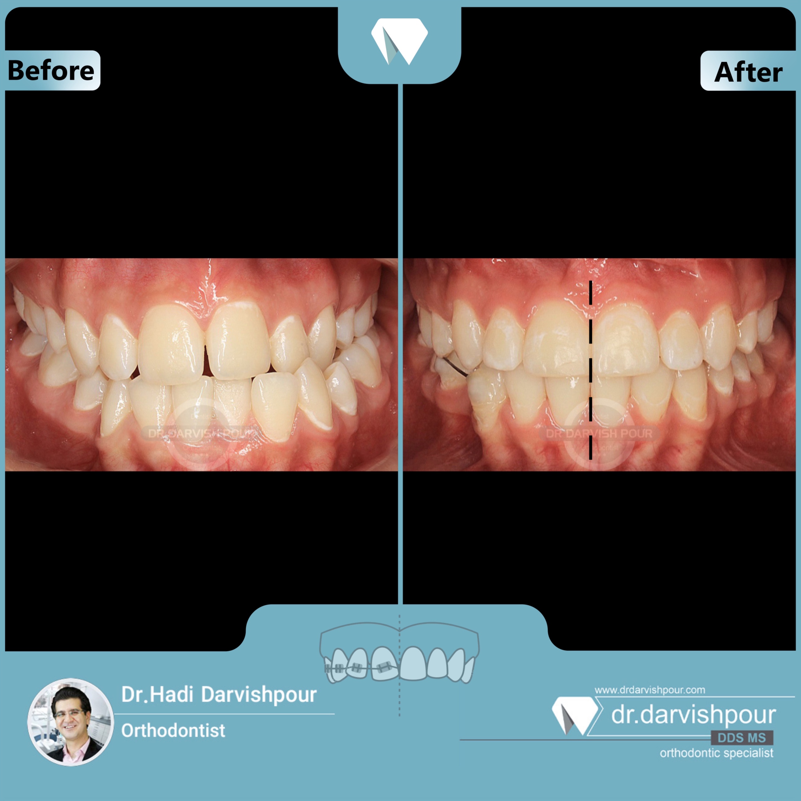 1696orthodontics-before-after-photo