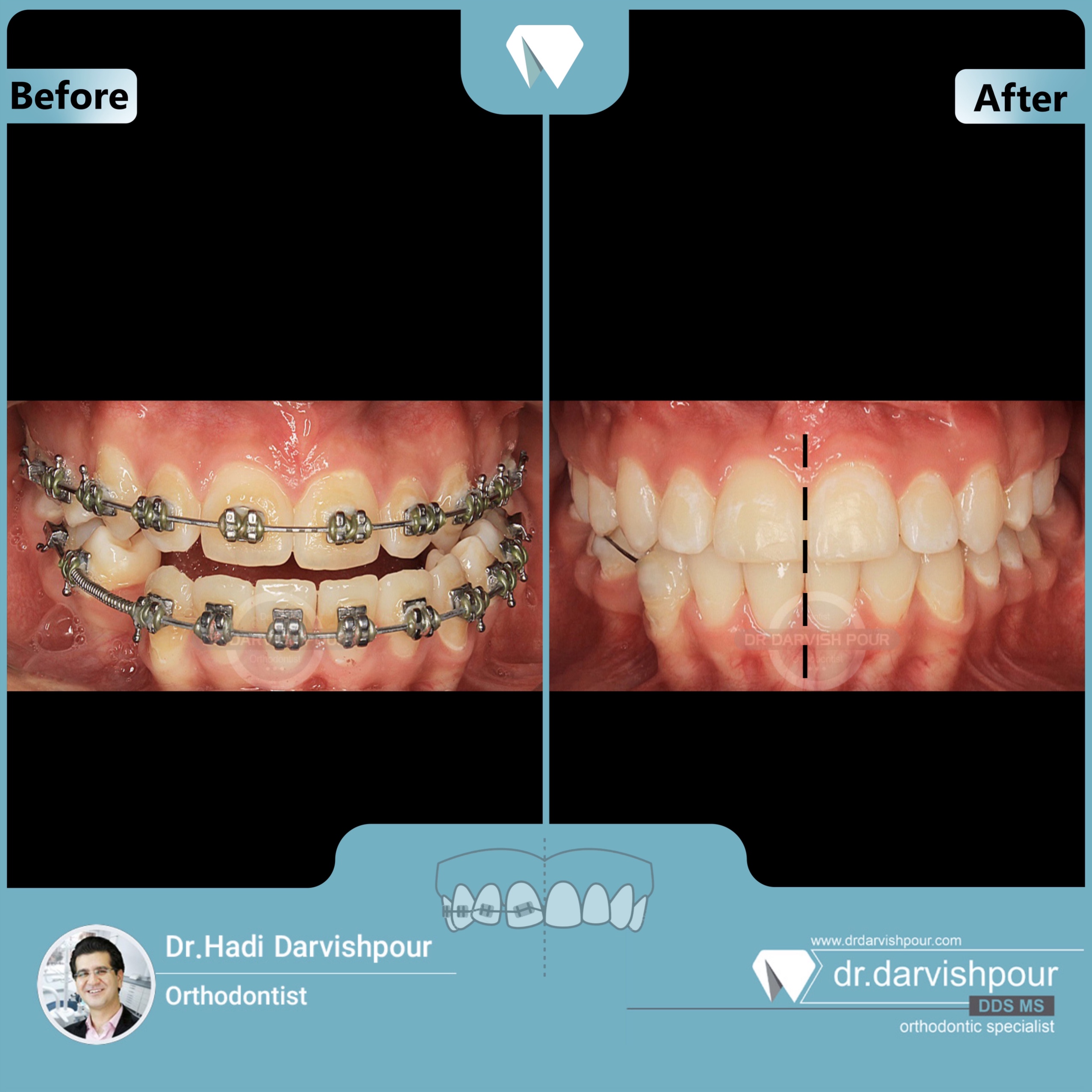 1697orthodontics-before-after-photo