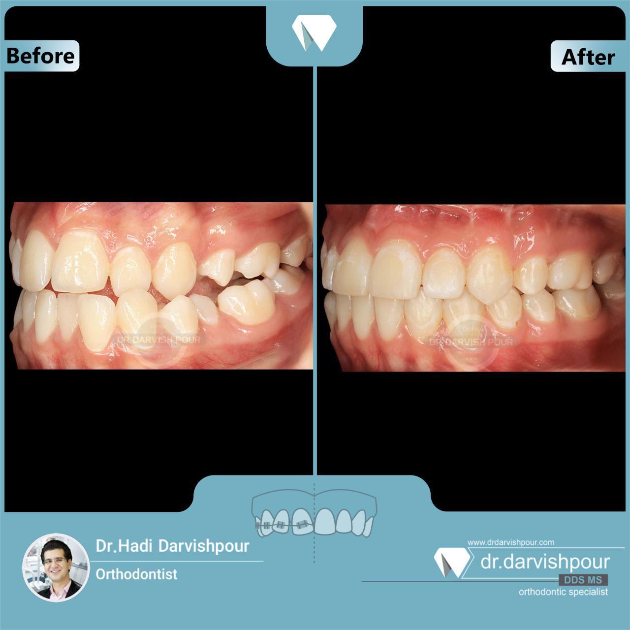 1698orthodontics-before-after-photo