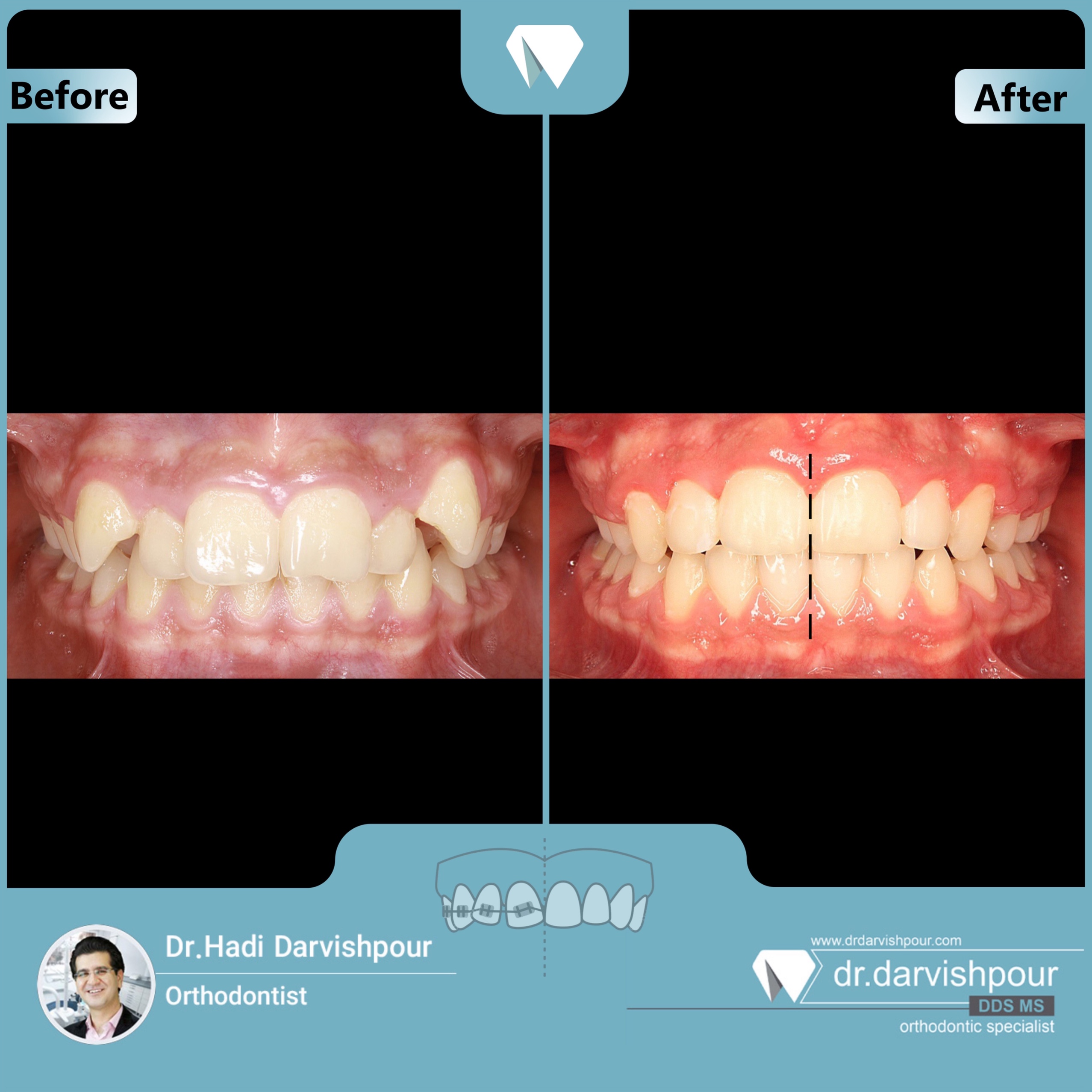 1701orthodontics-before-after-photo