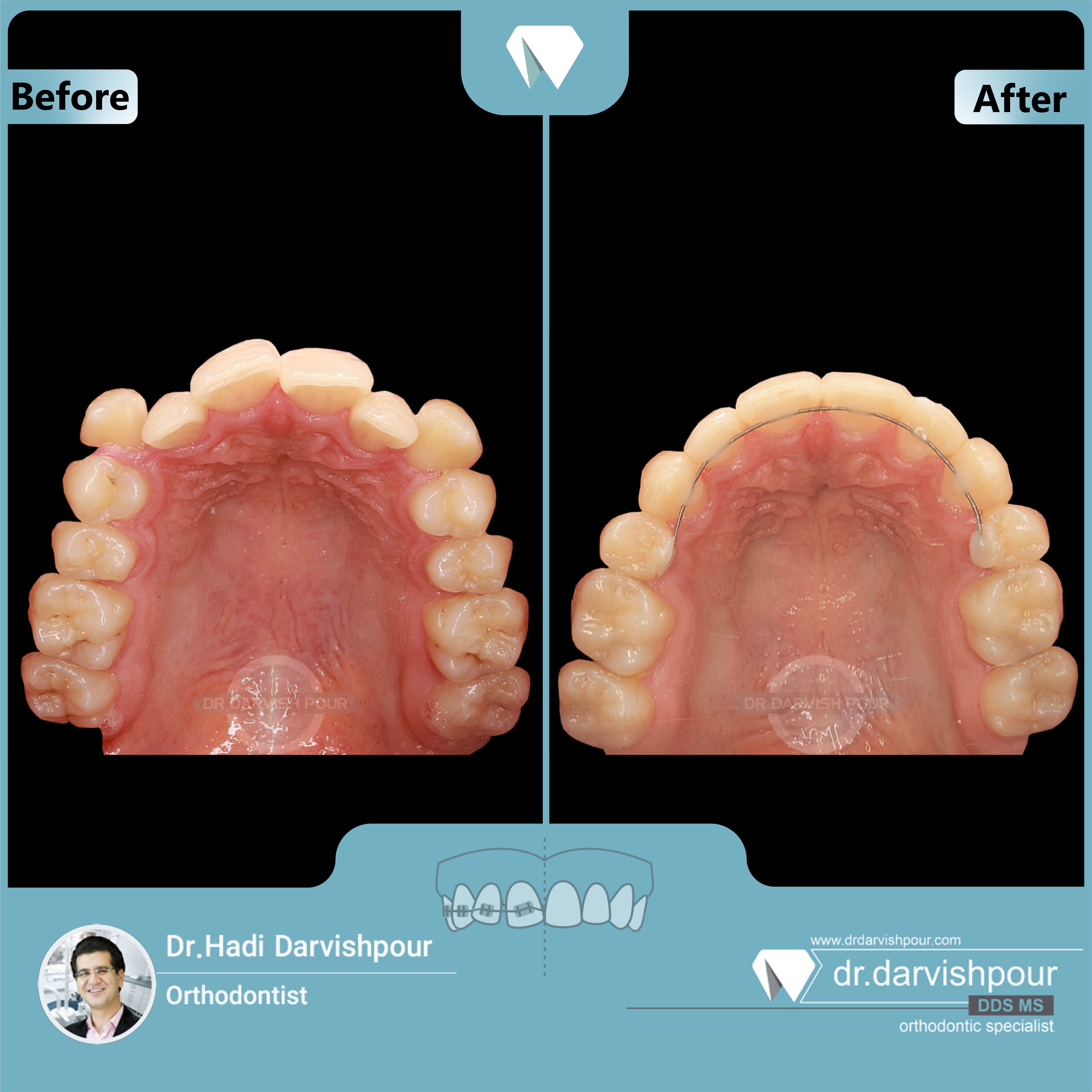 1702orthodontics-before-after-photo