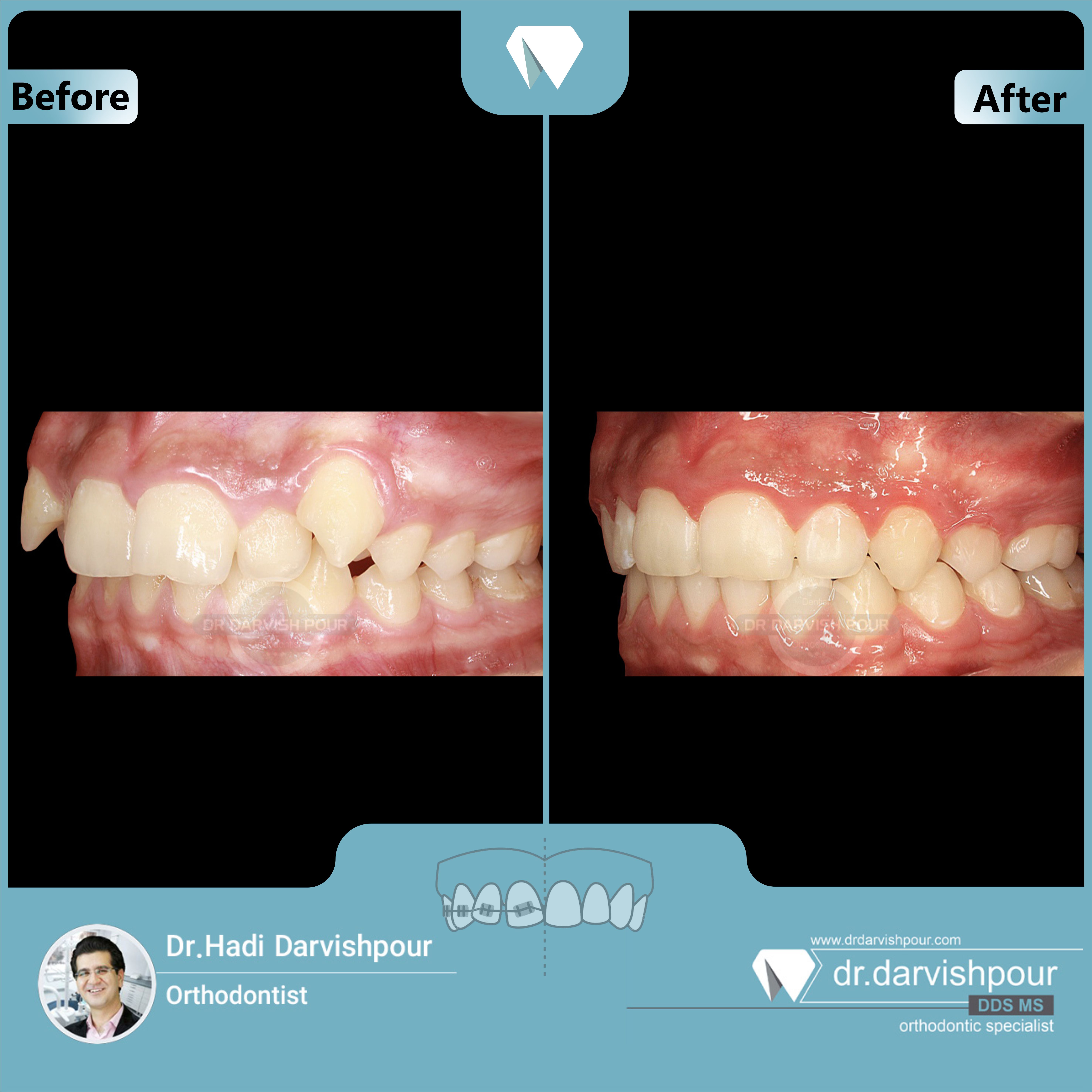 1703orthodontics-before-after-photo