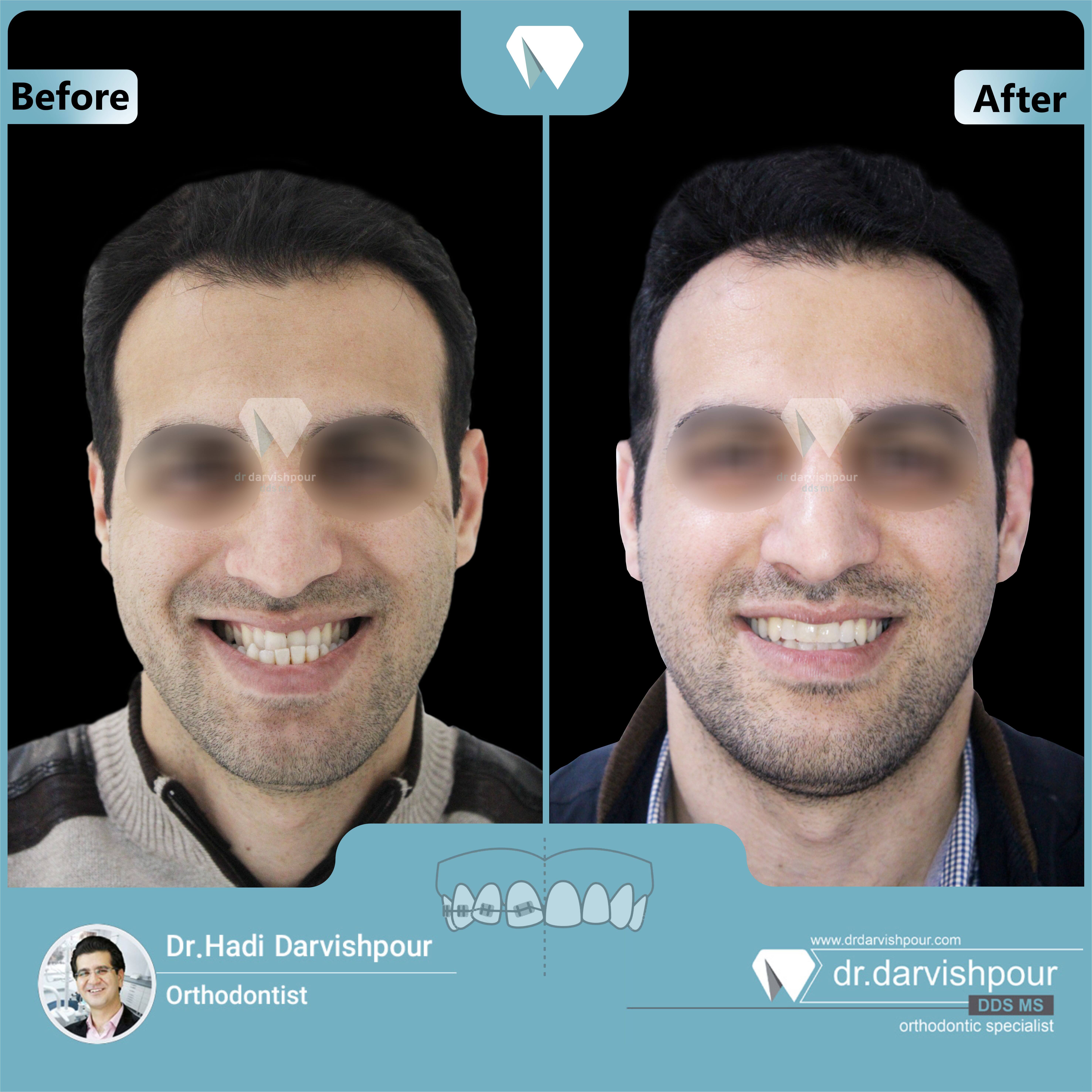 1706orthodontics-before-after-photo
