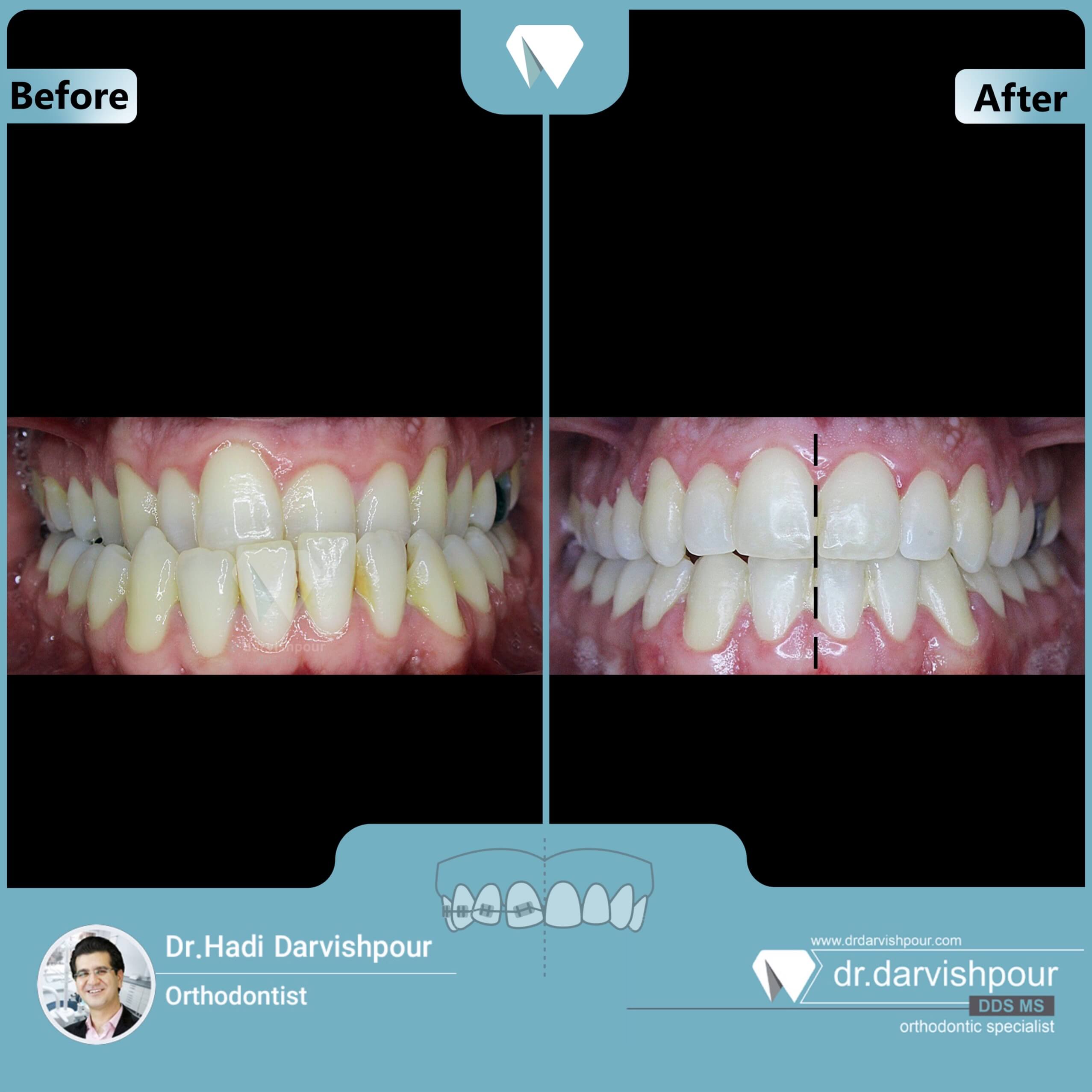 1707orthodontics-before-after-photo