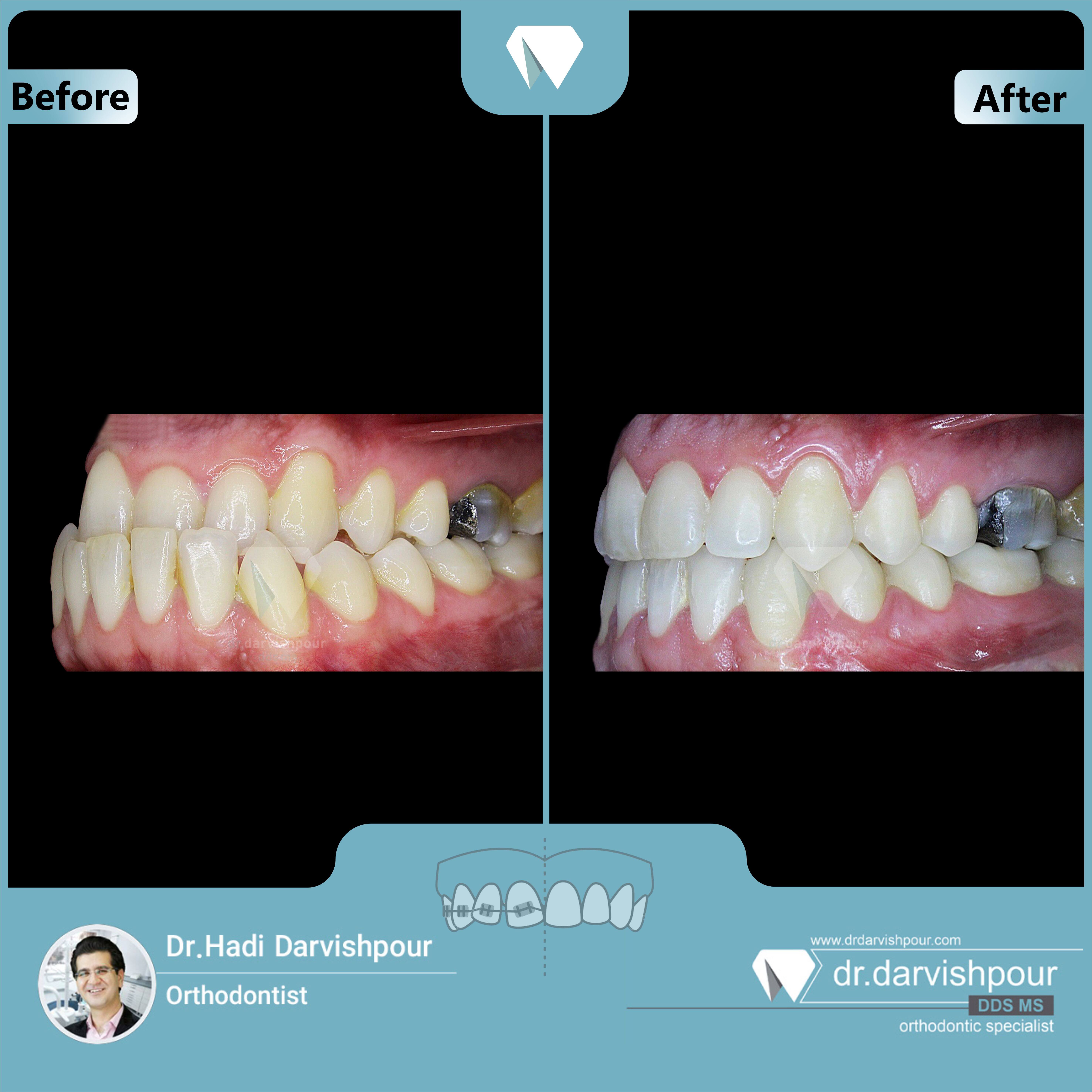 1708orthodontics-before-after-photo