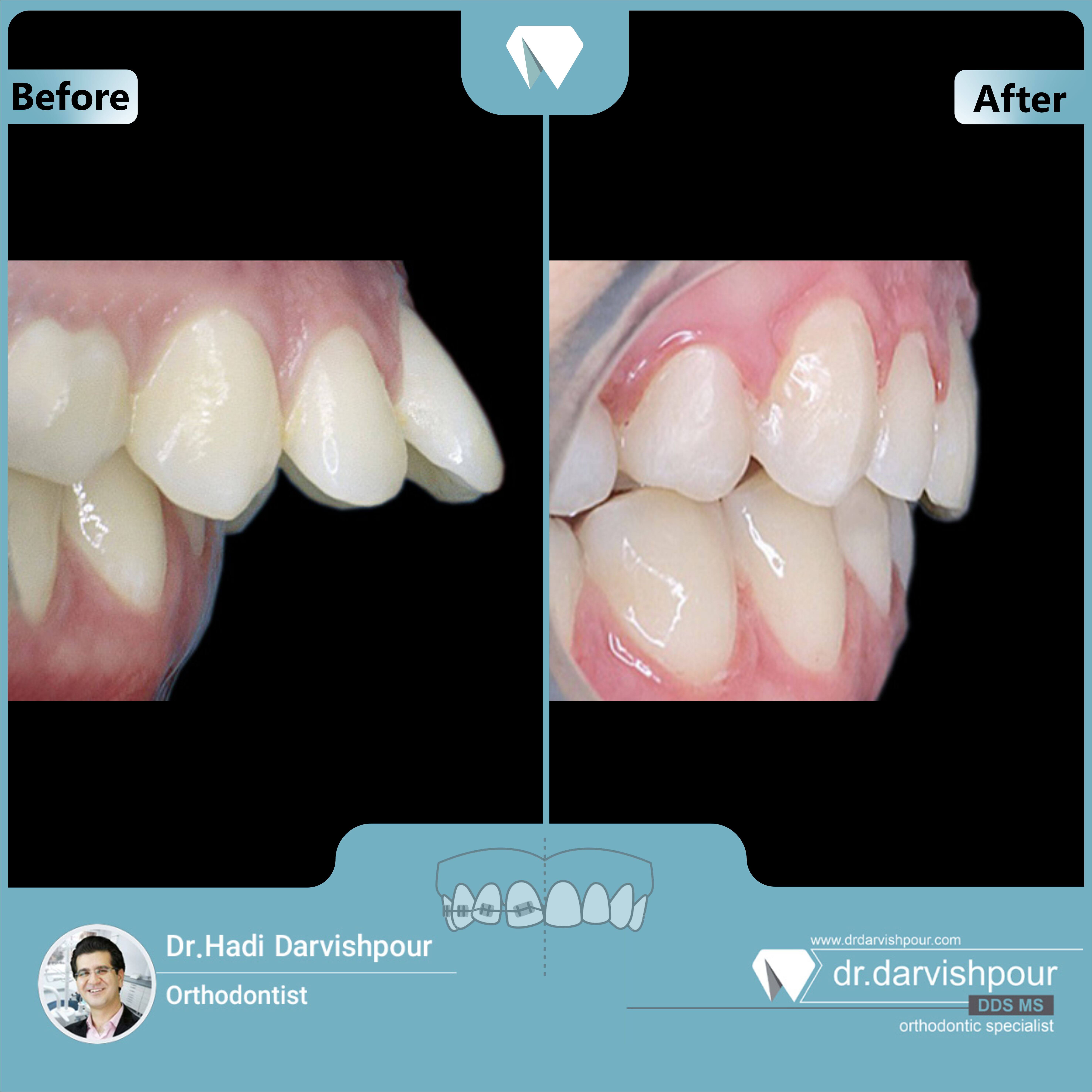 1710orthodontics-before-after-photo