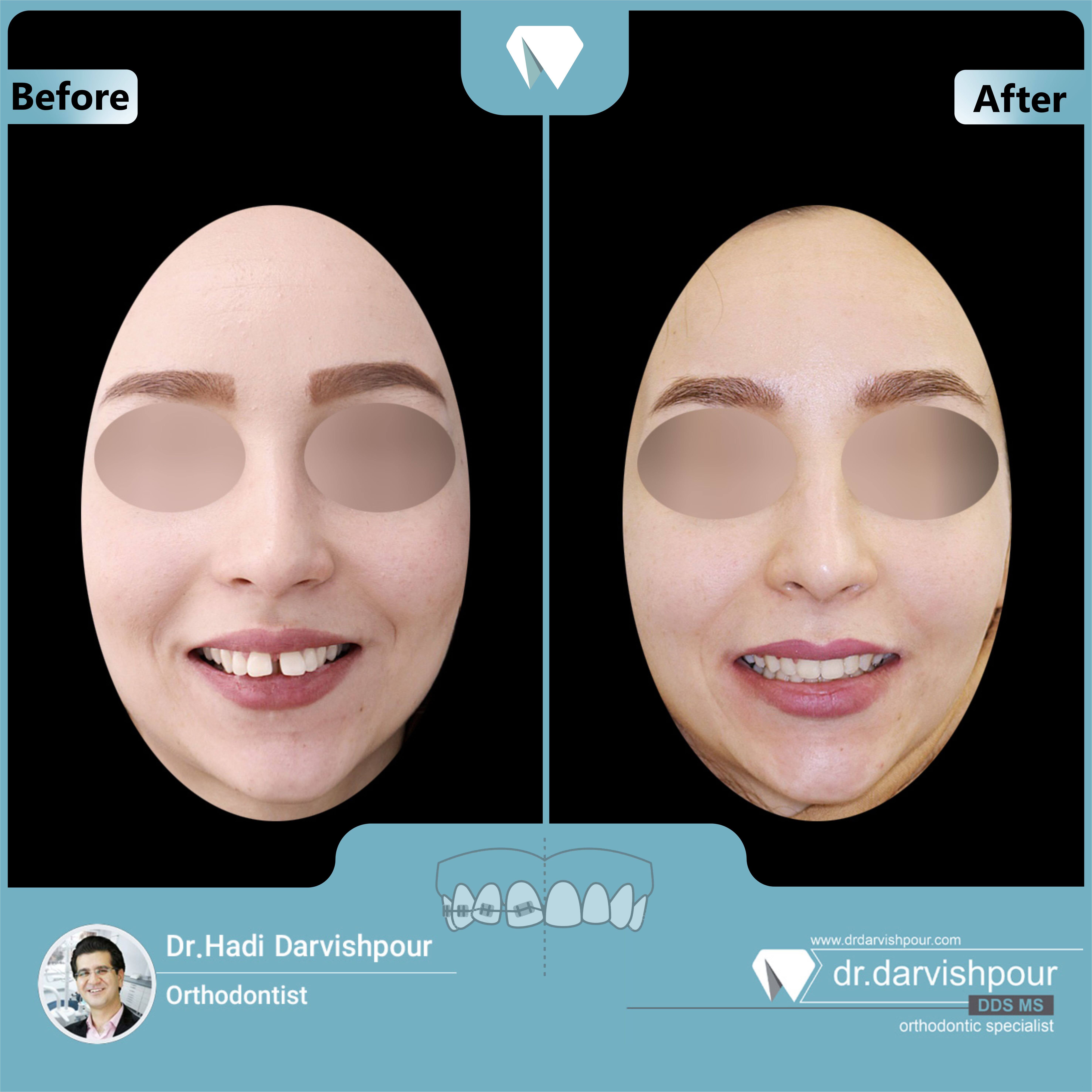 1711orthodontics-before-after-photo