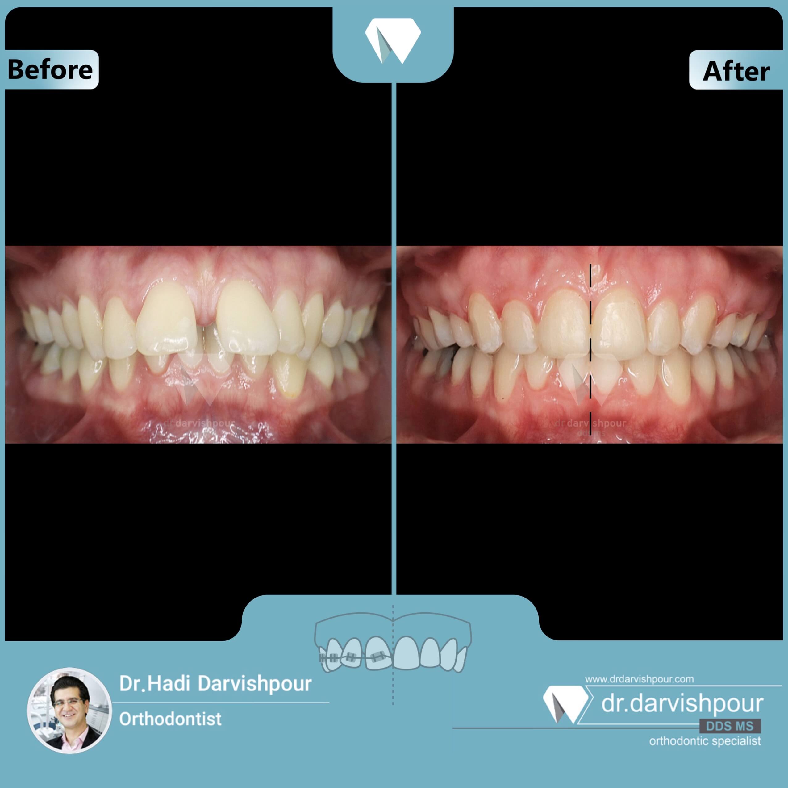 1712orthodontics-before-after-photo