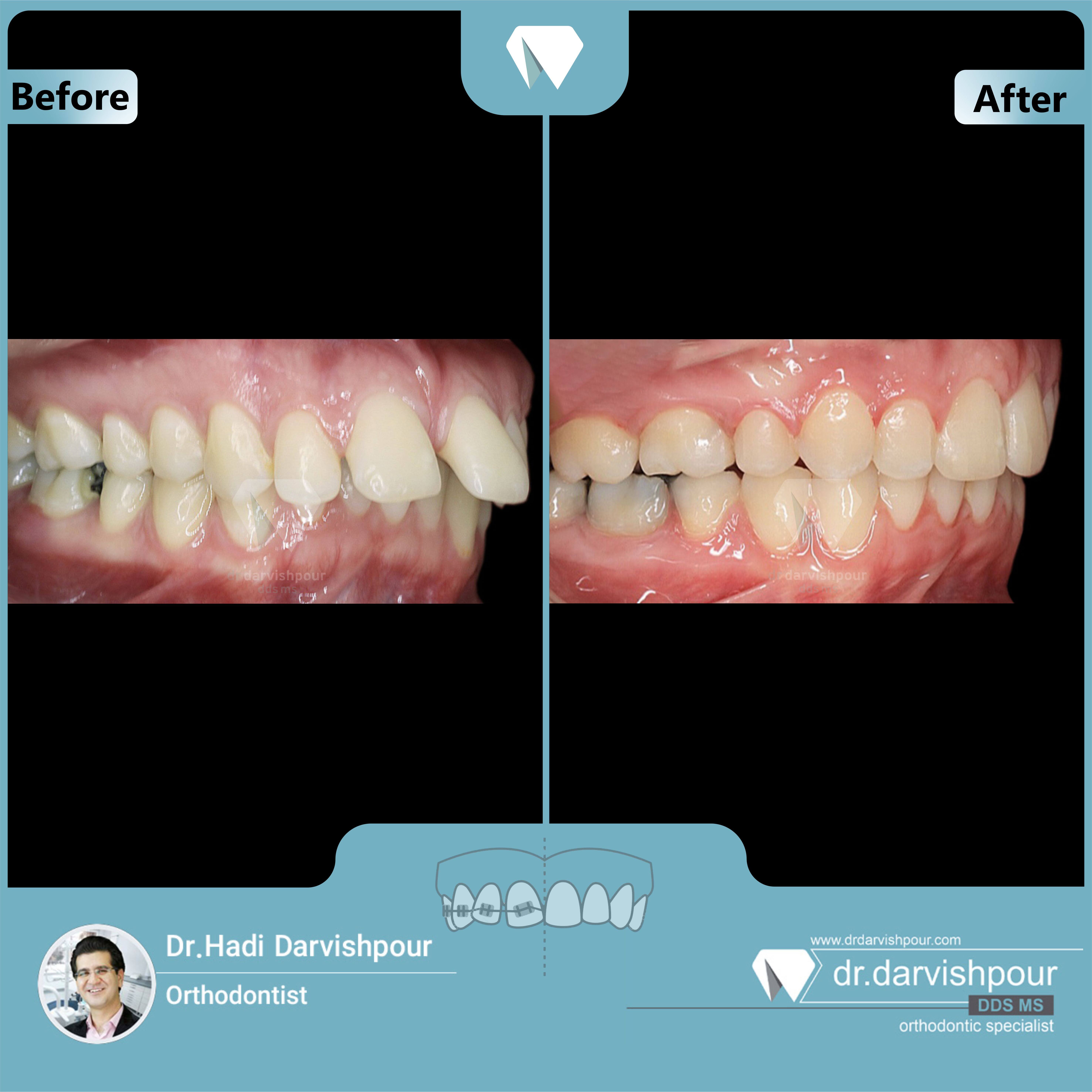 1713orthodontics-before-after-photo
