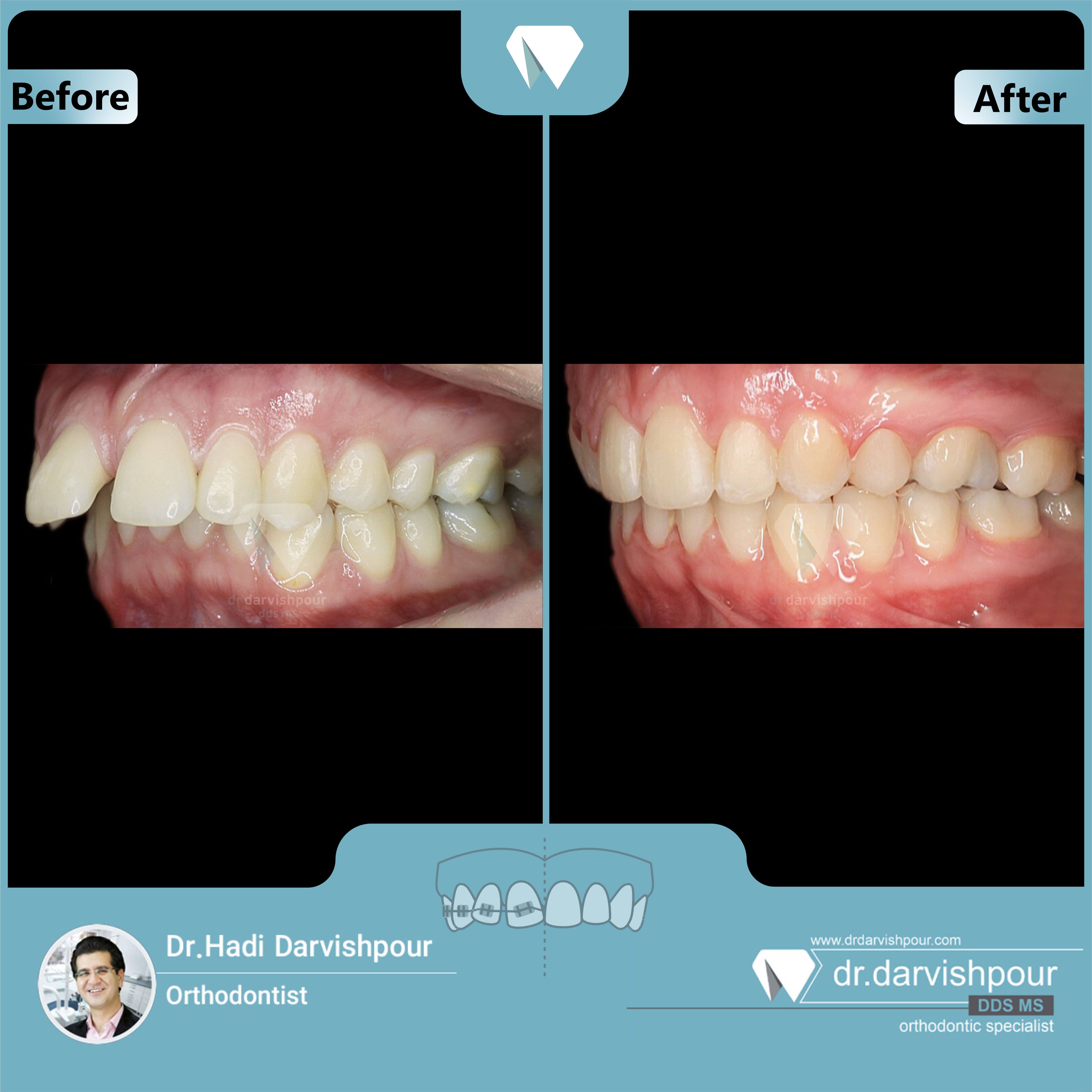 1714orthodontics-before-after-photo