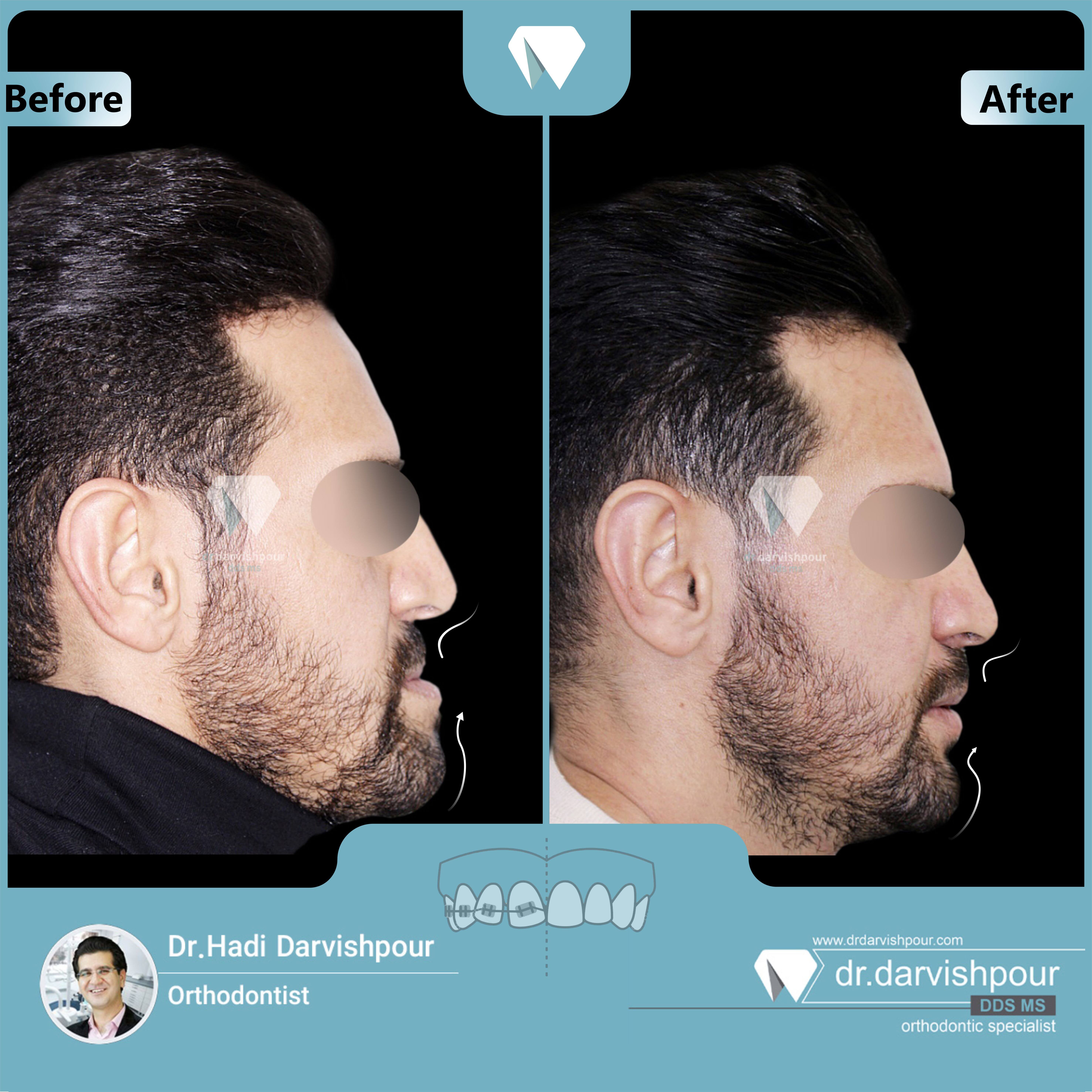 1716orthodontics-before-after-photo