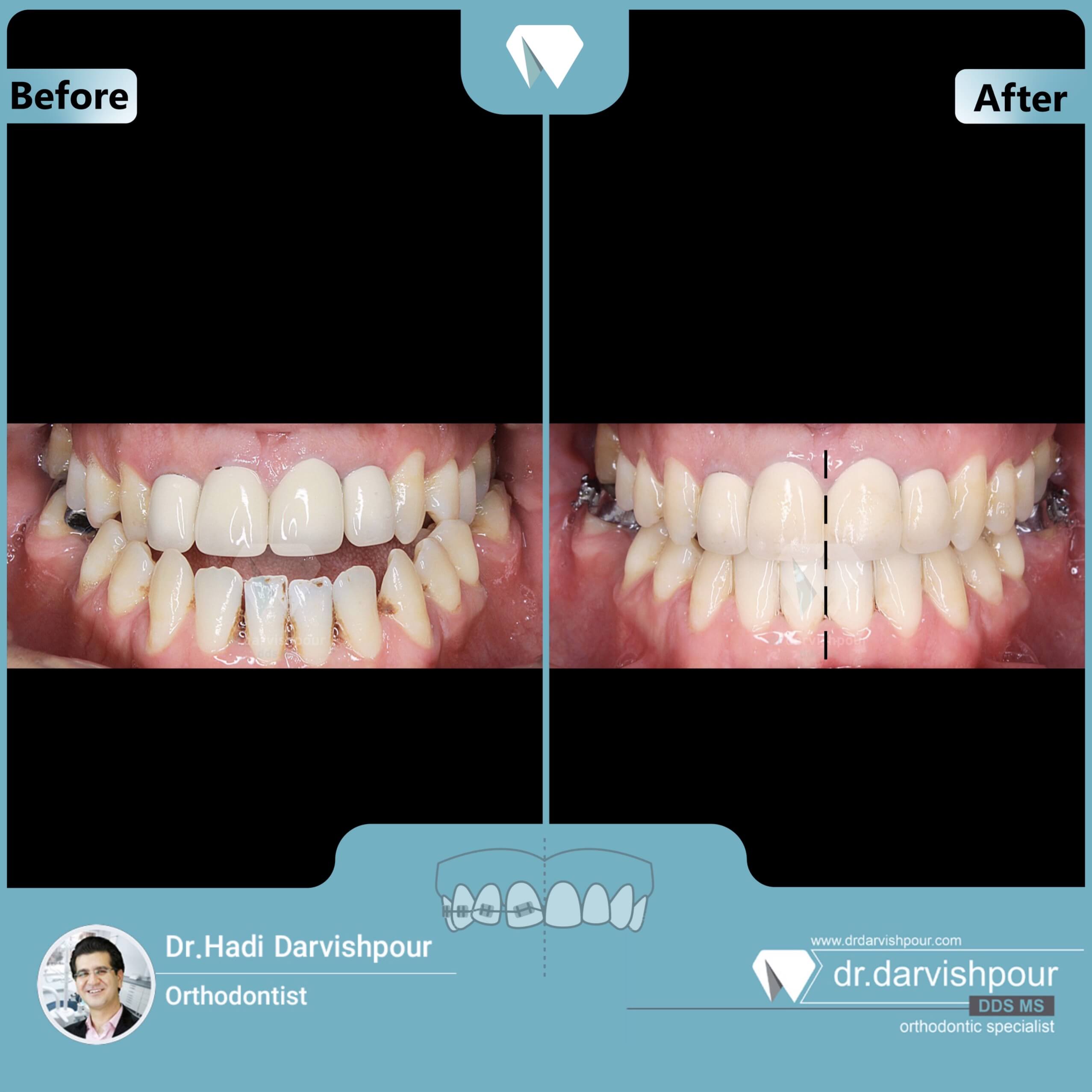 1717orthodontics-before-after-photo