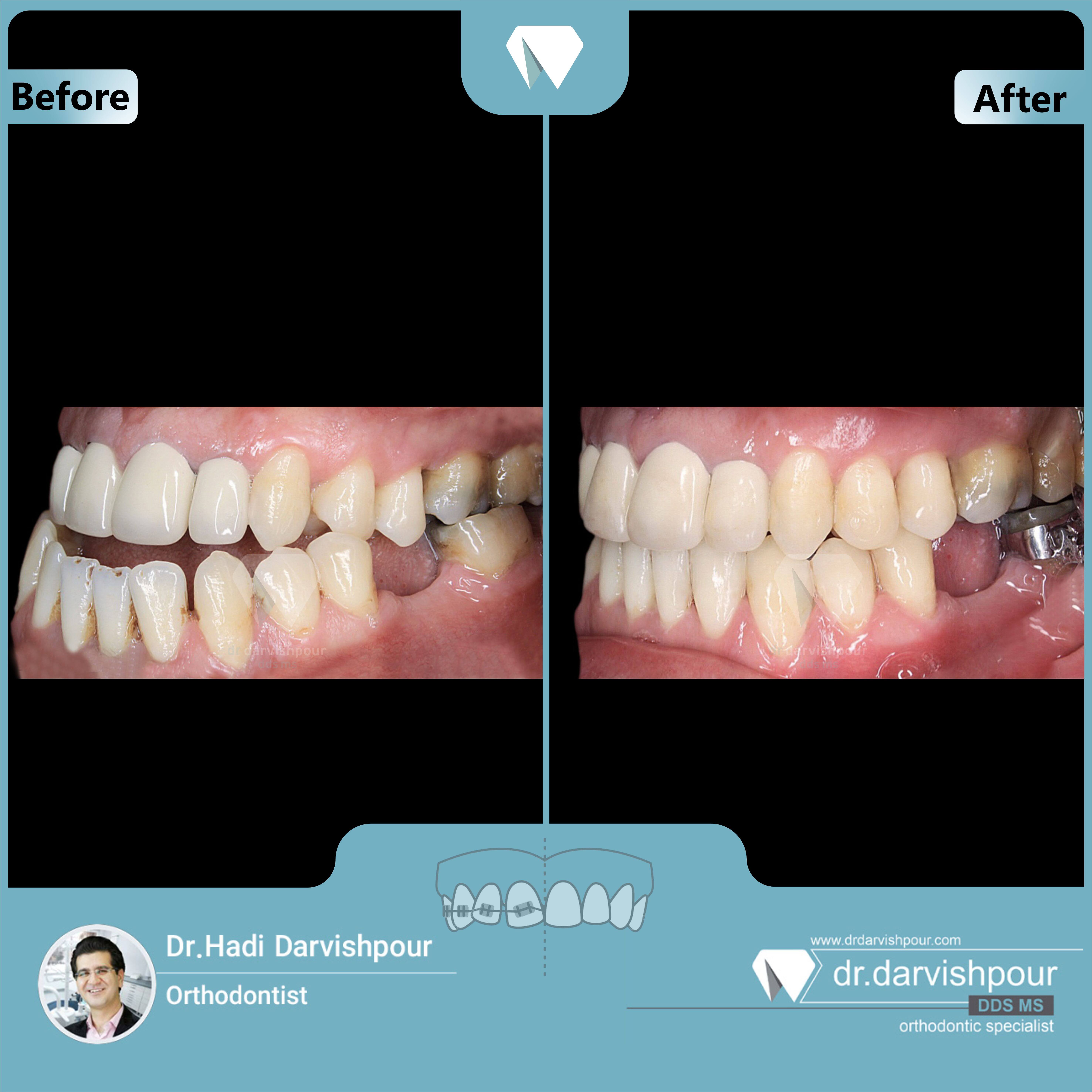 1718orthodontics-before-after-photo