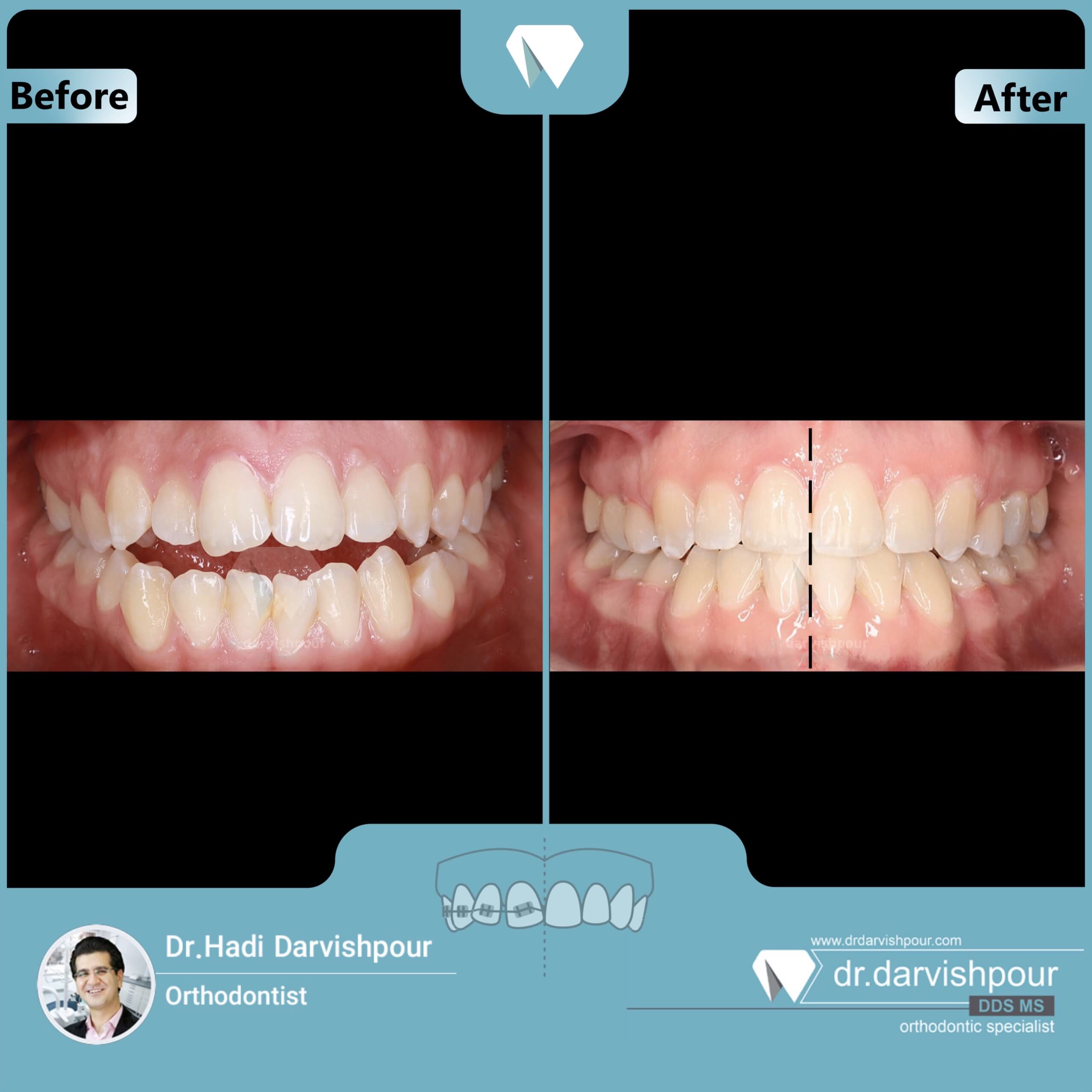 1720orthodontics-before-after-photo