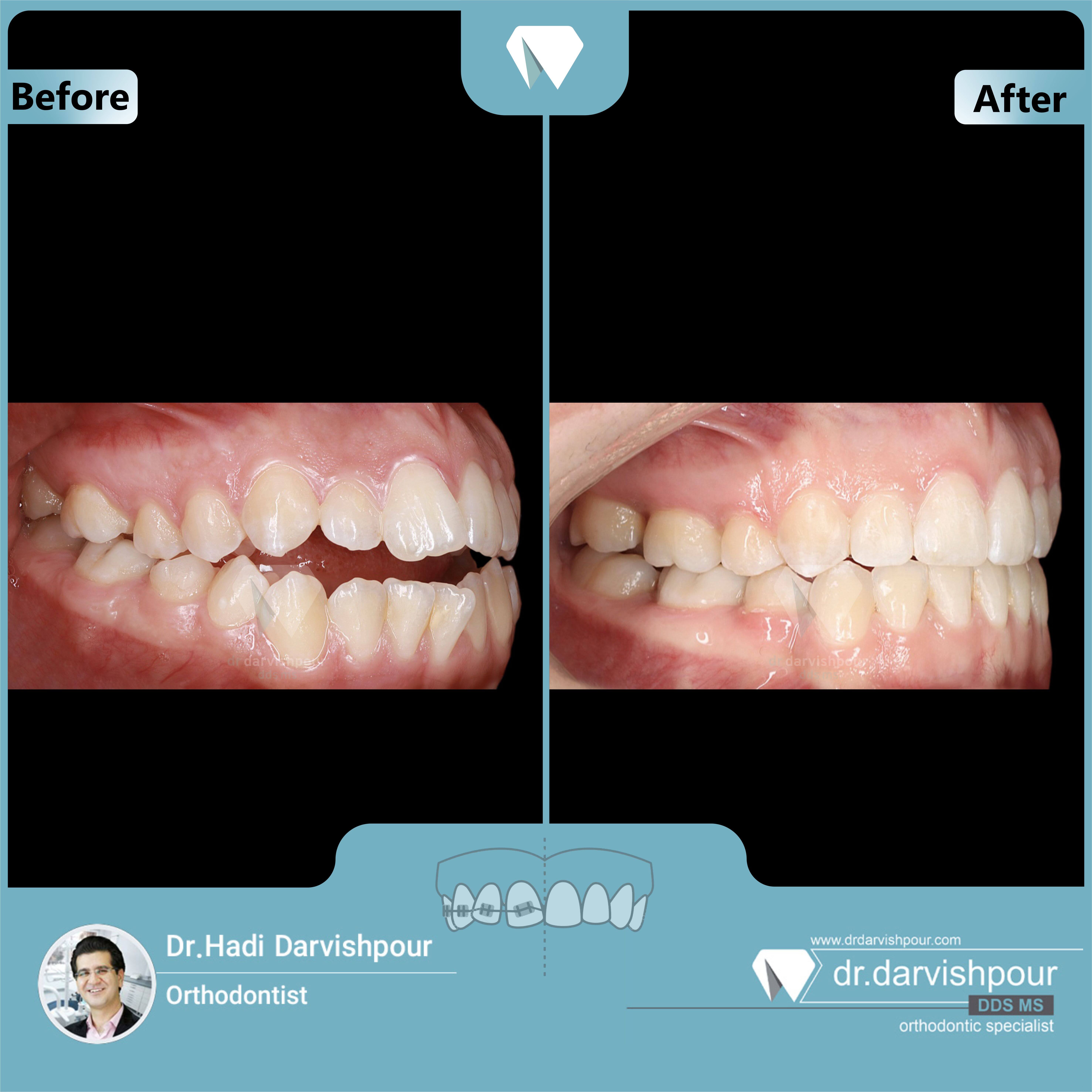 1721orthodontics-before-after-photo