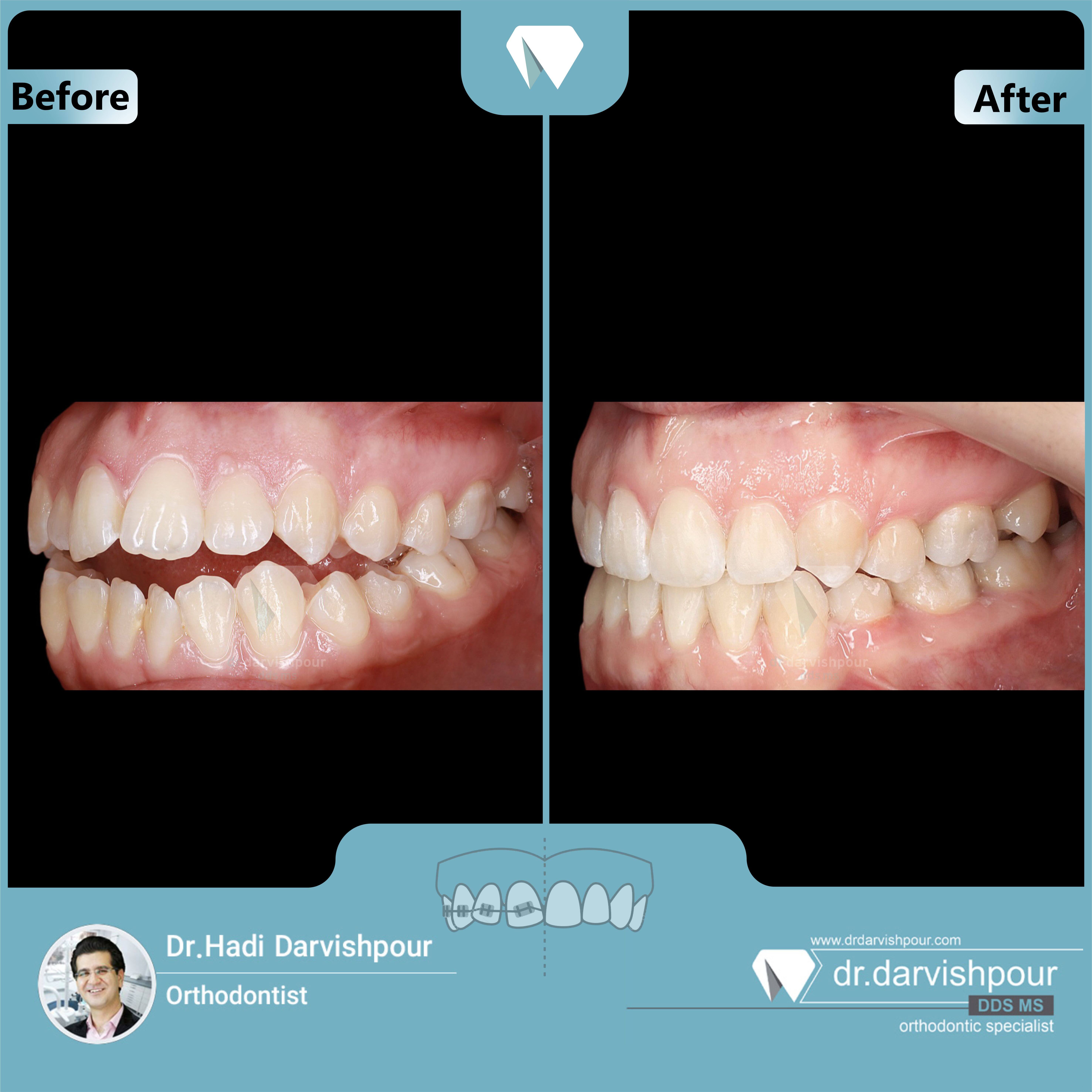 1722orthodontics-before-after-photo