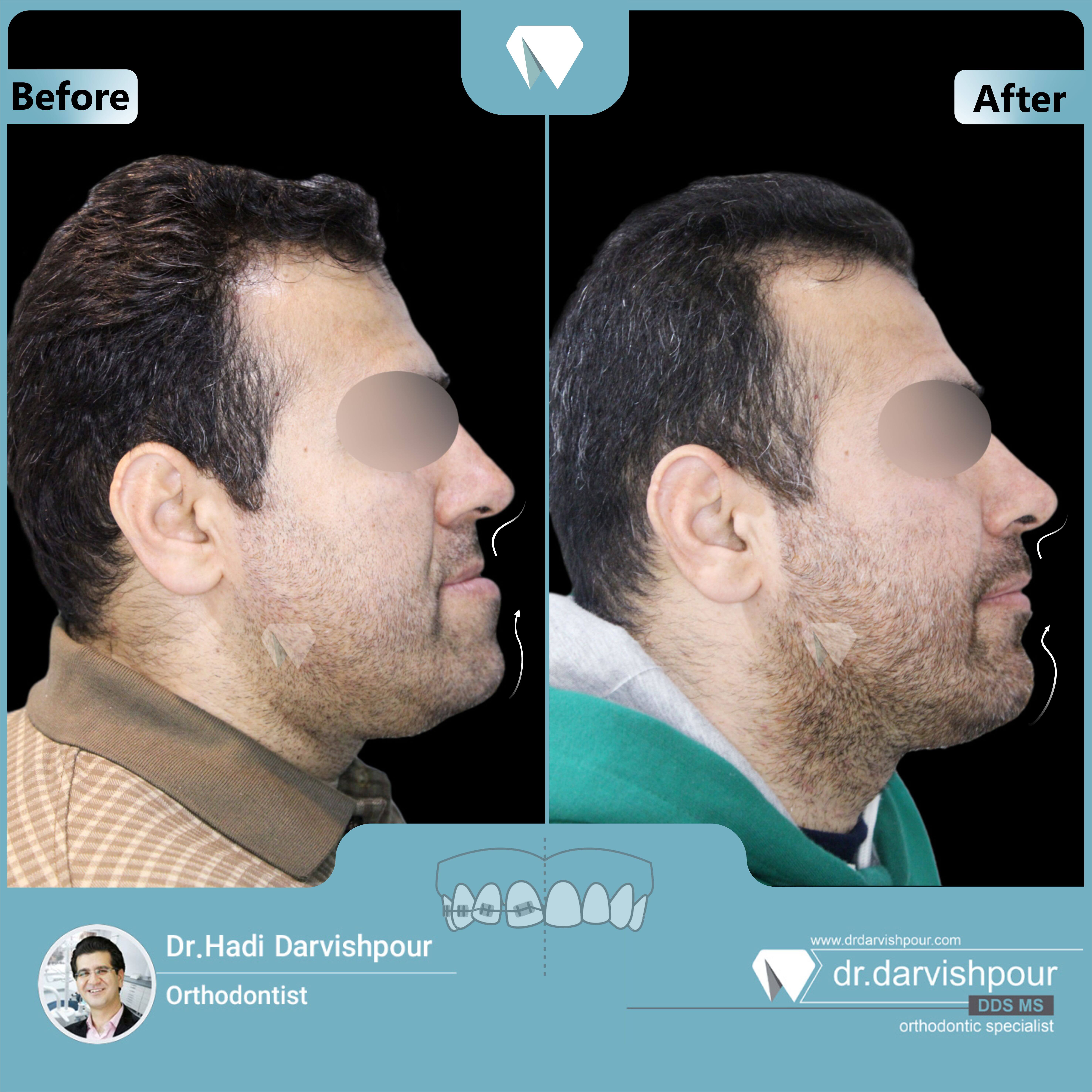 1725orthodontics-before-after-photo