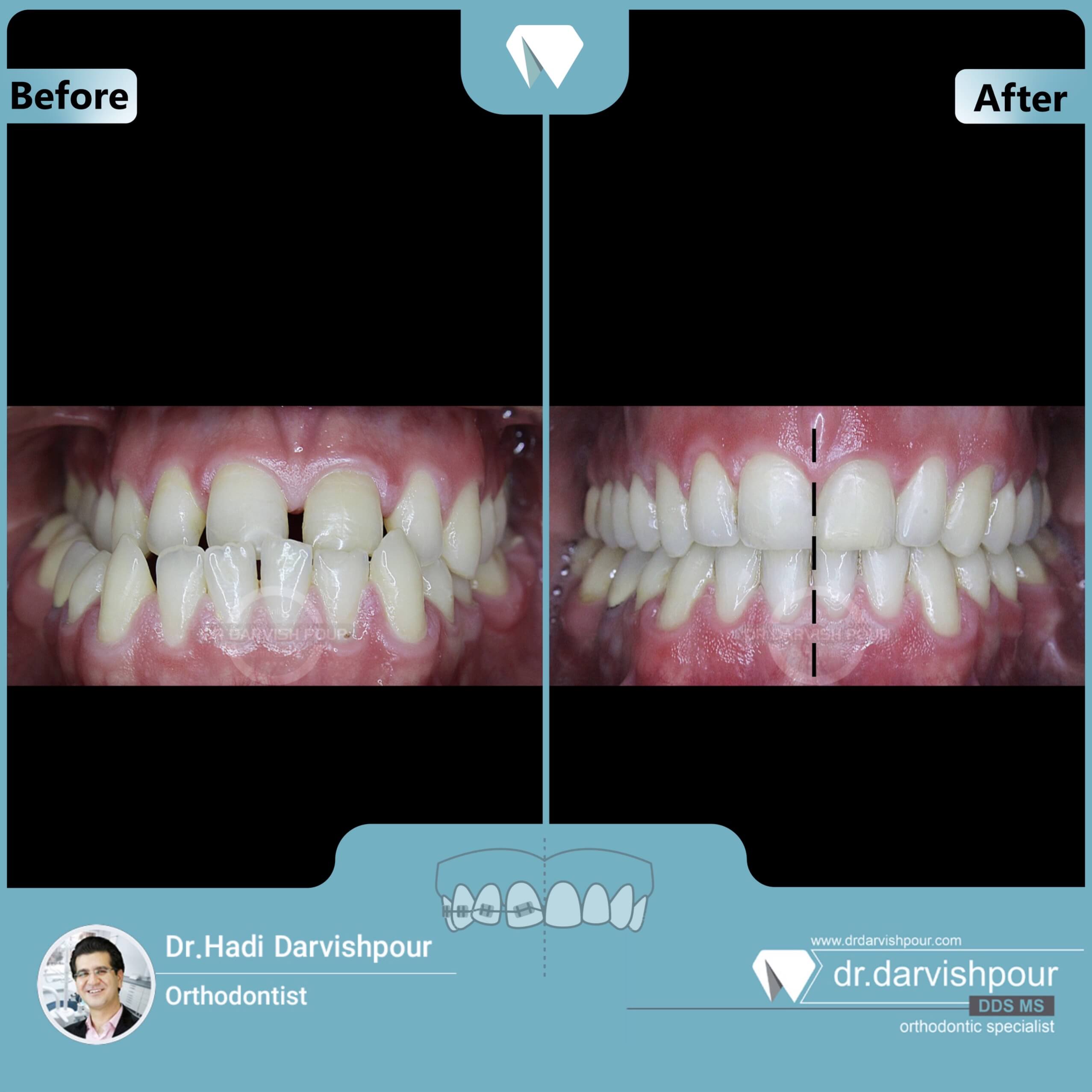 1726orthodontics-before-after-photo