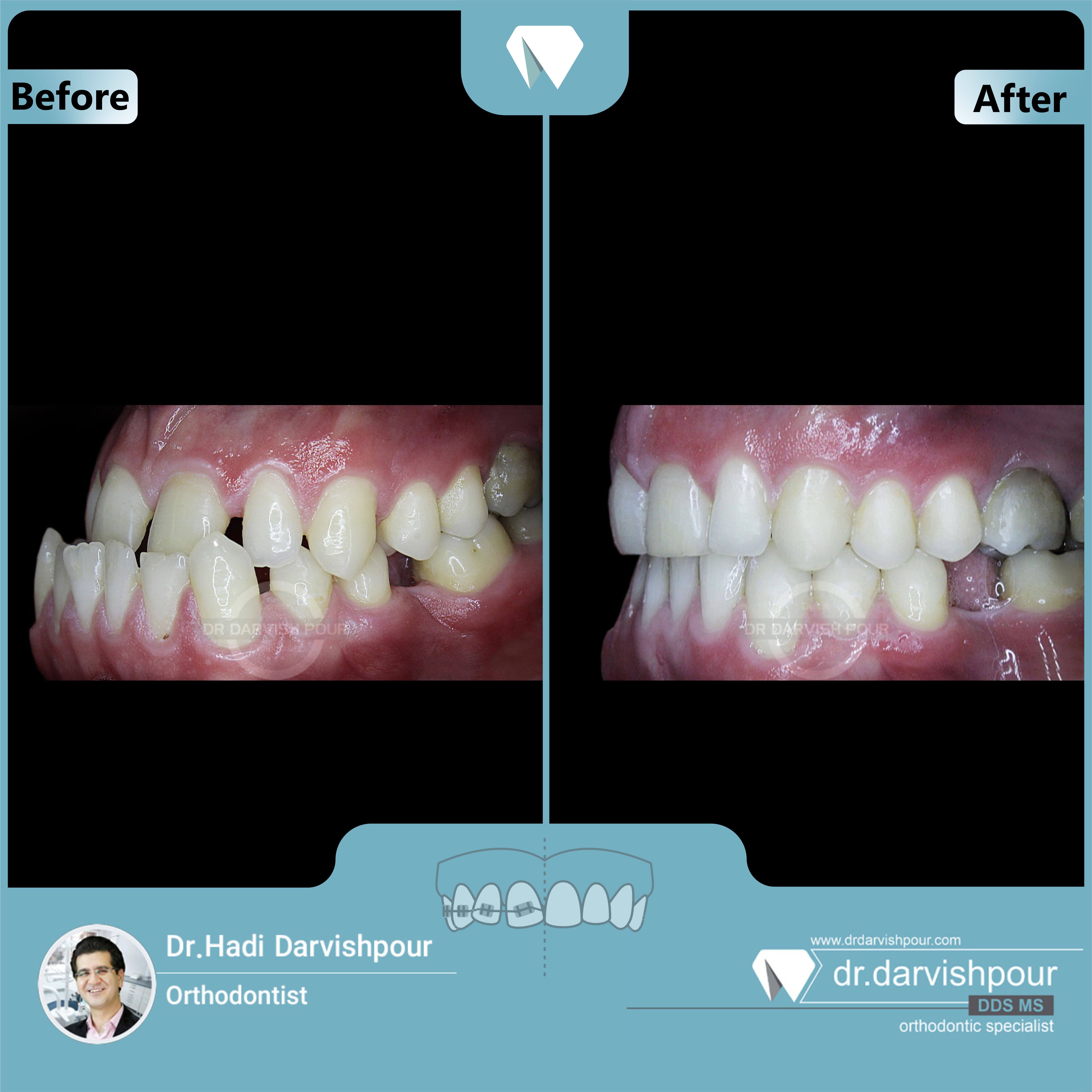 1727orthodontics-before-after-photo