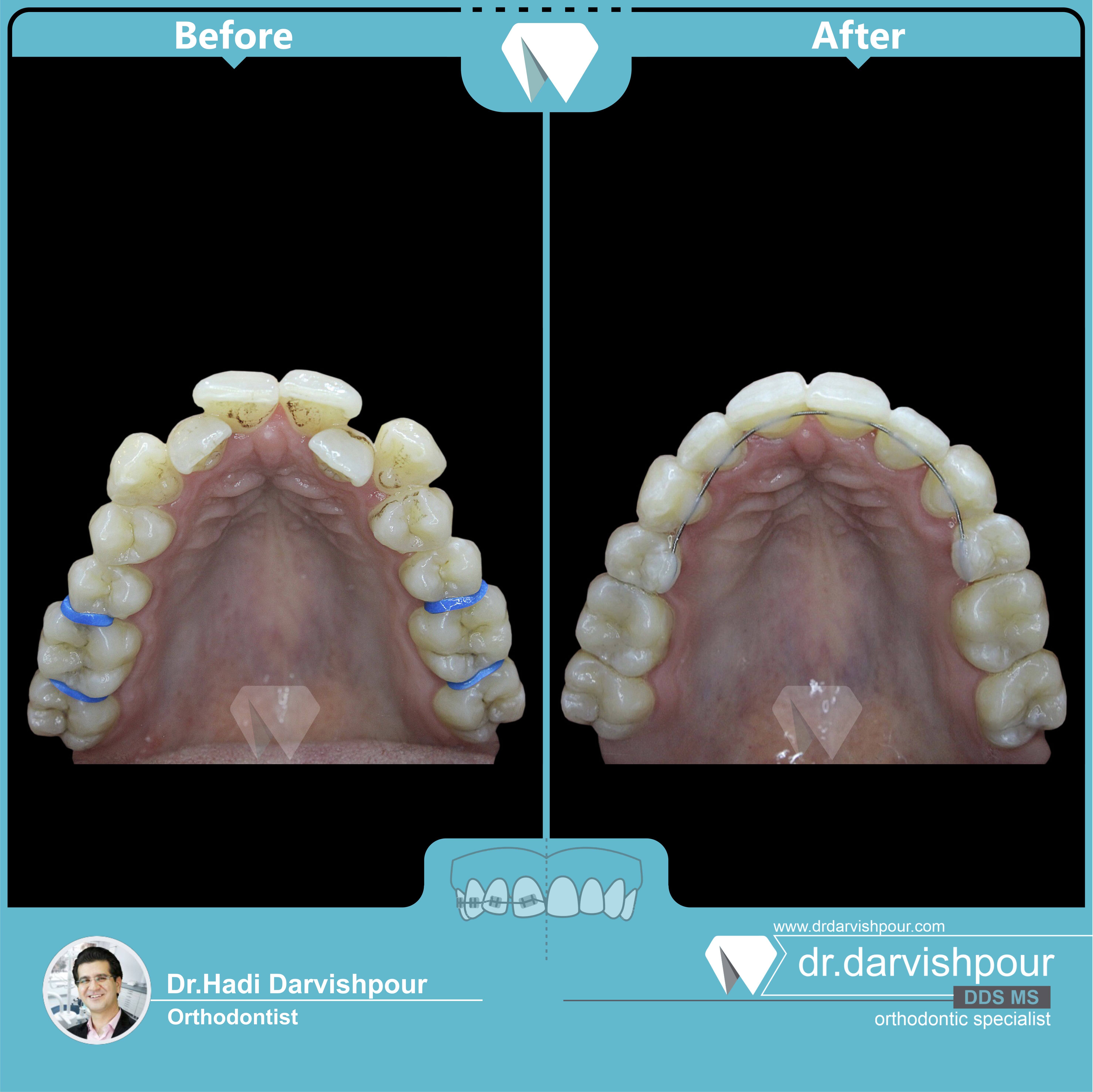 1728orthodontics-before-after-photo