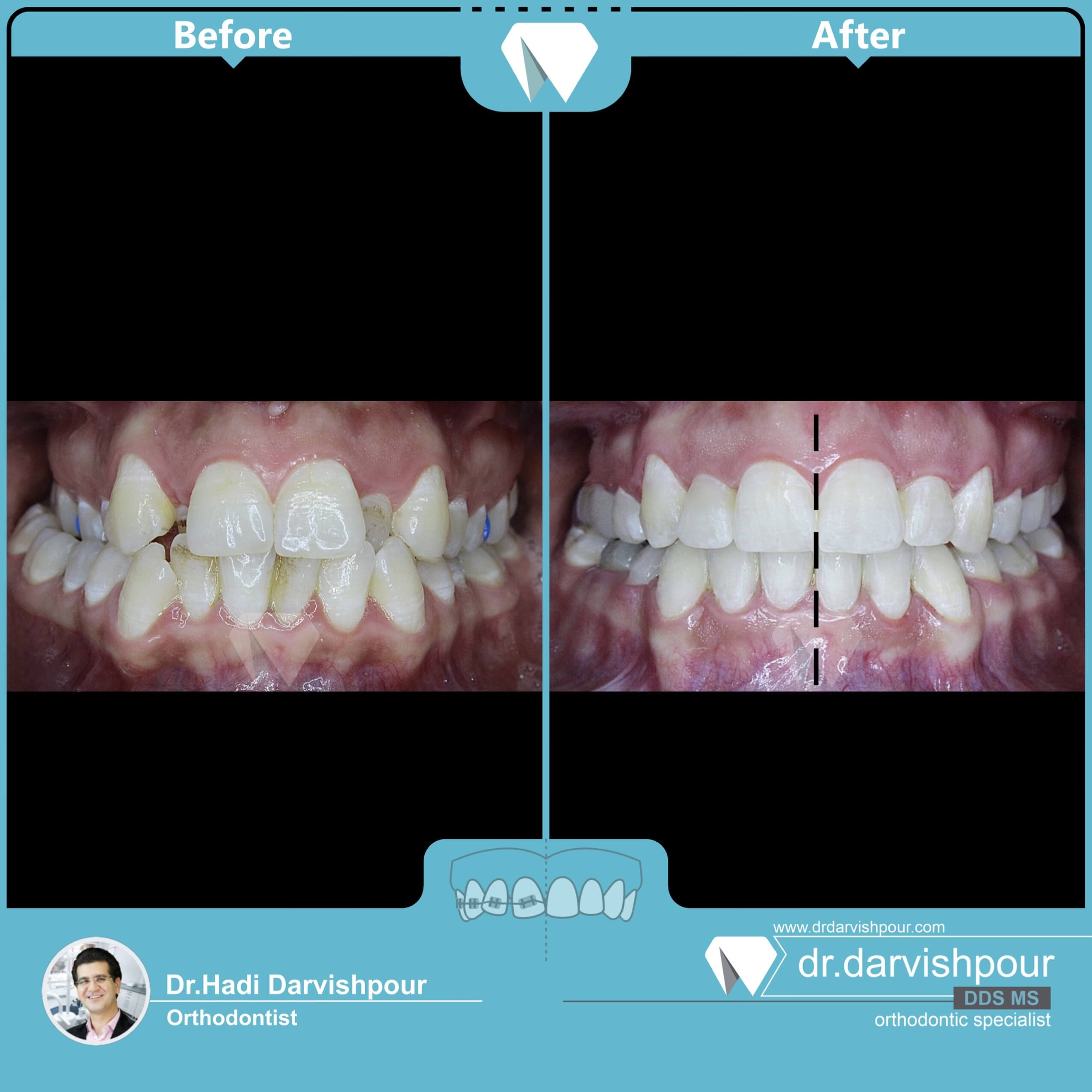 1729orthodontics-before-after-photo