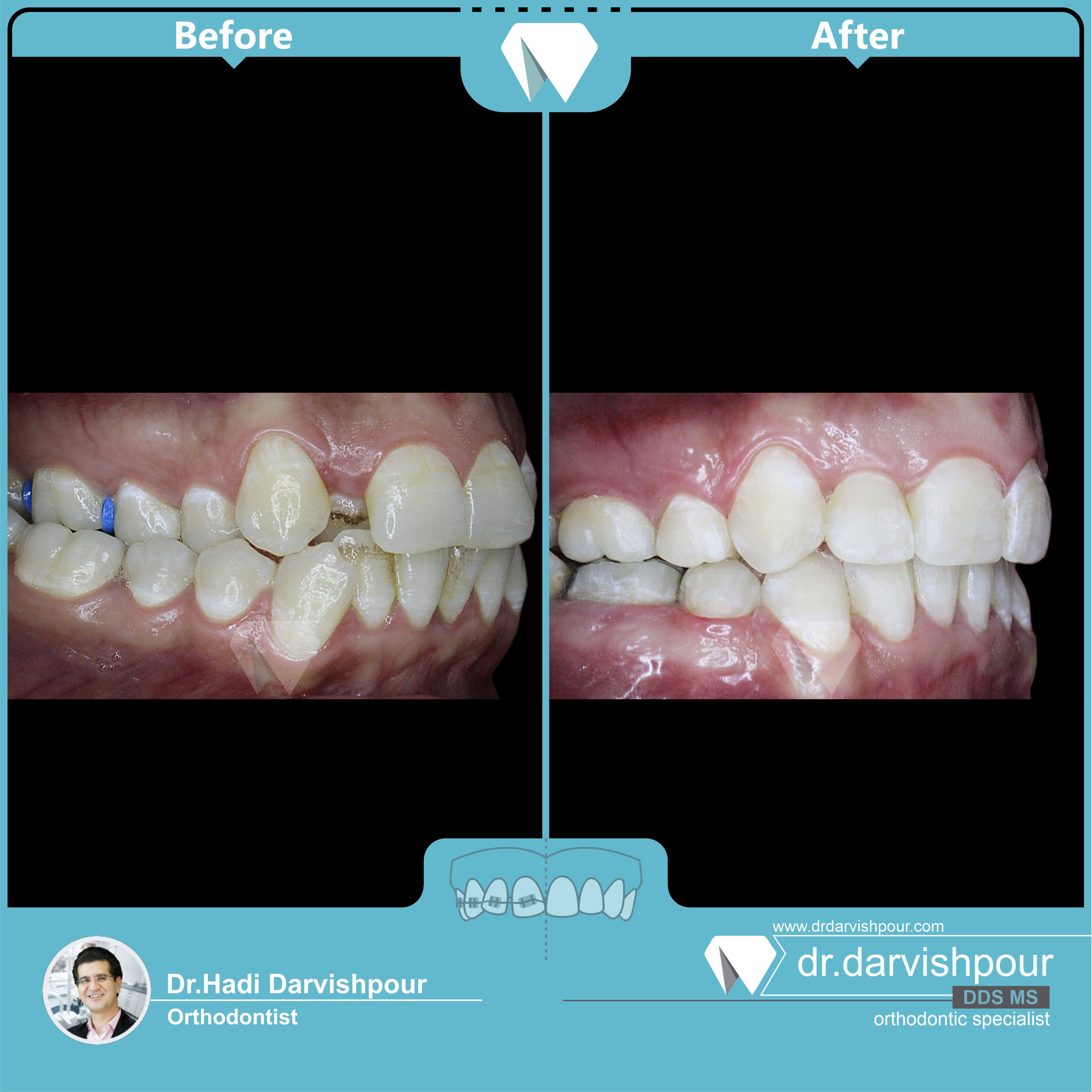 1730orthodontics-before-after-photo