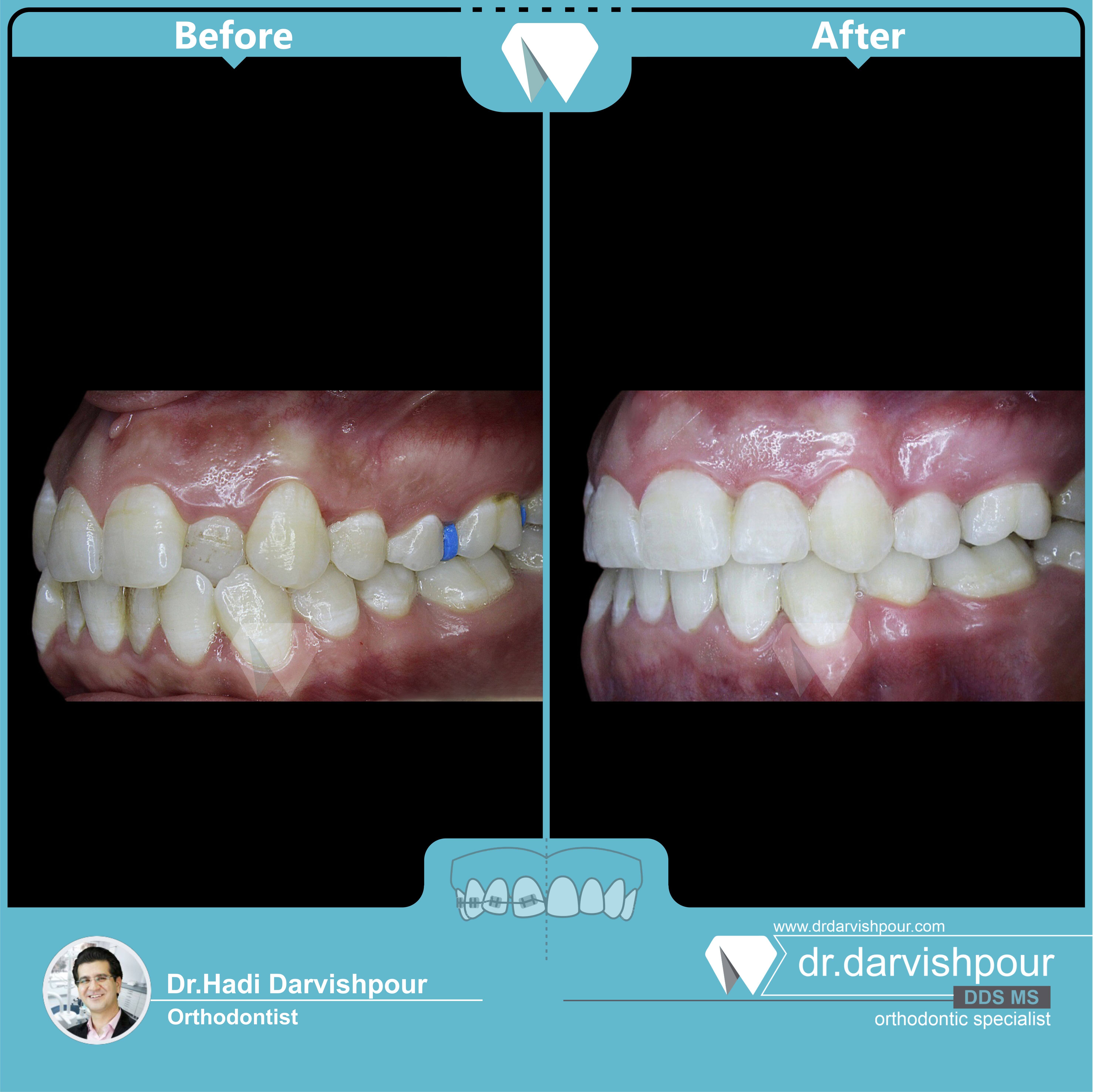 1731orthodontics-before-after-photo