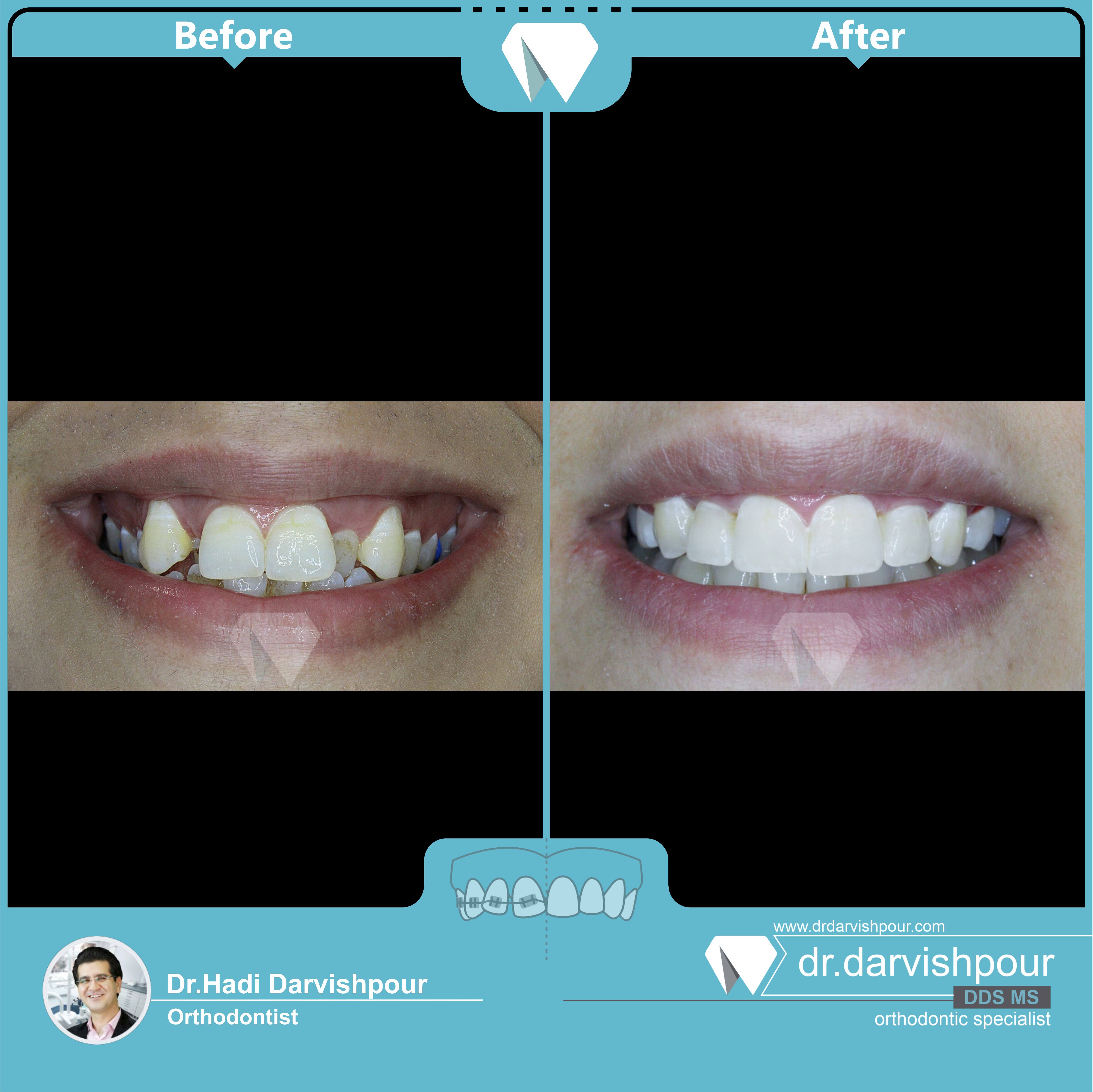 1732orthodontics-before-after-photo