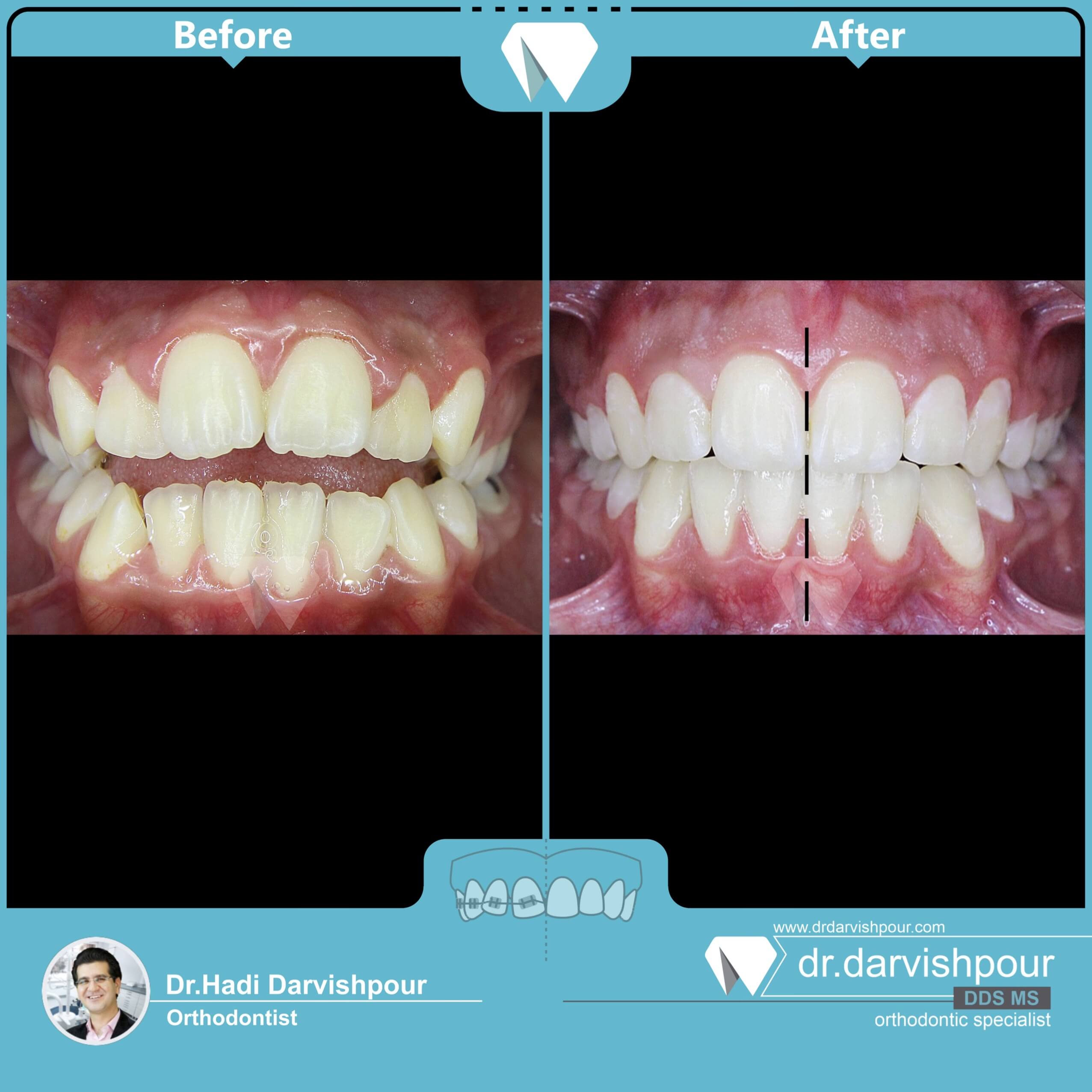 1734orthodontics-before-after-photo