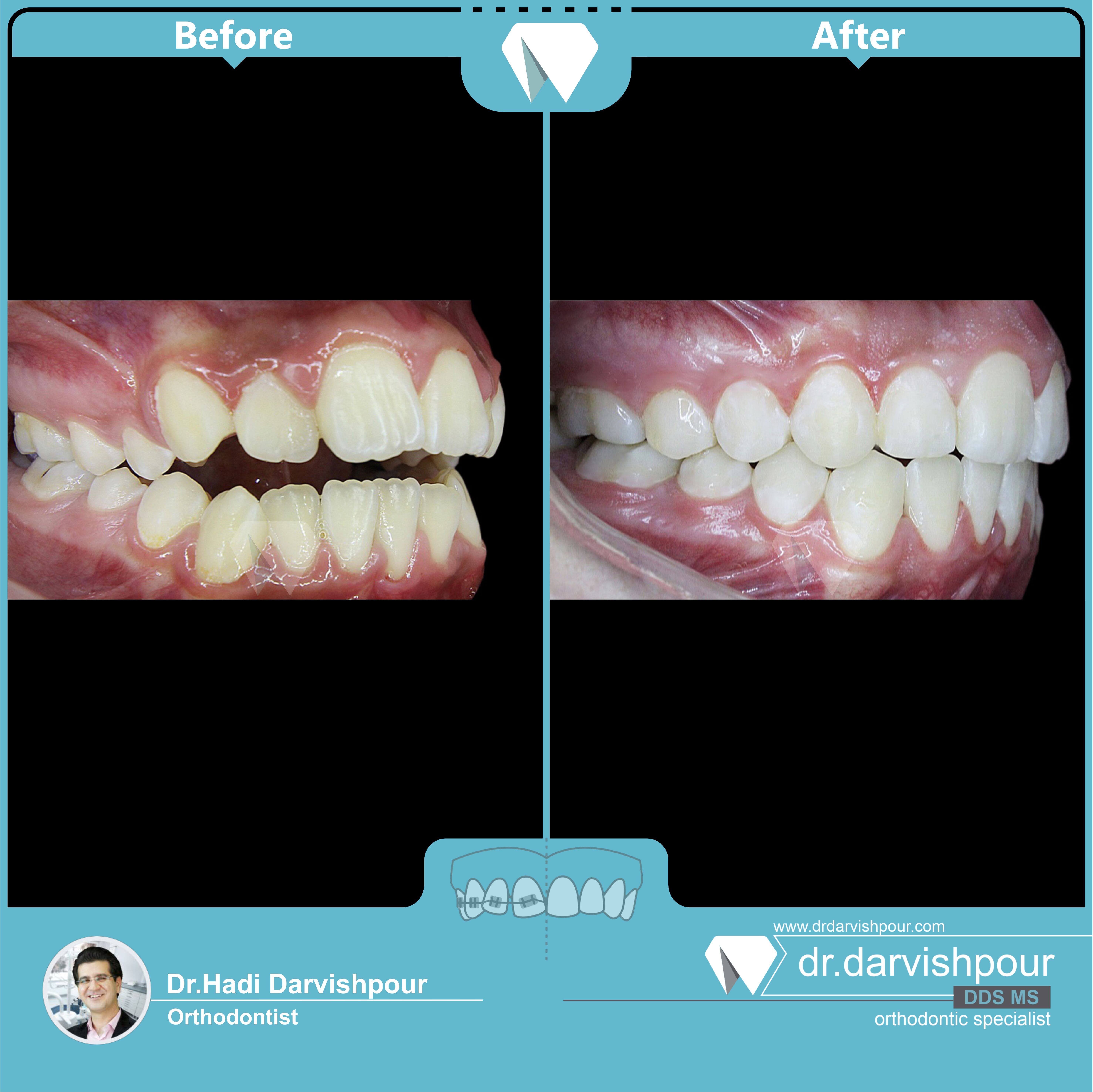1735orthodontics-before-after-photo