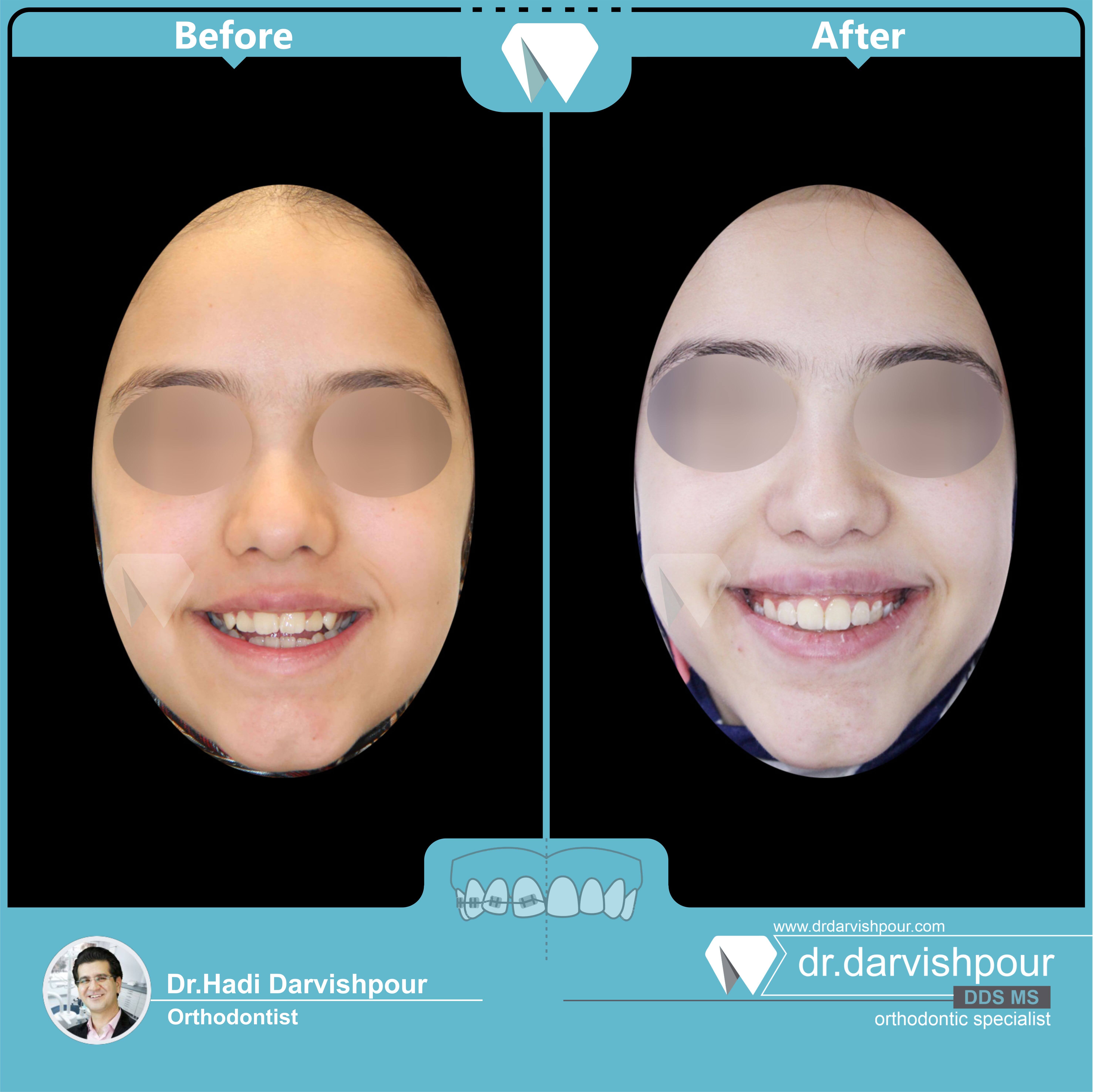 1736orthodontics-before-after-photo