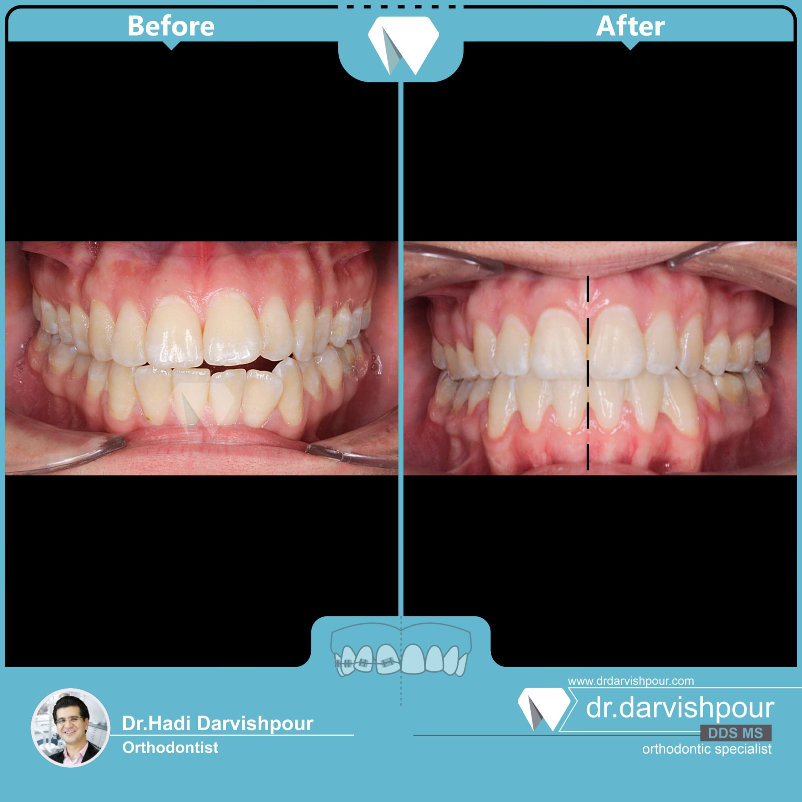 1738orthodontics-before-after-photo