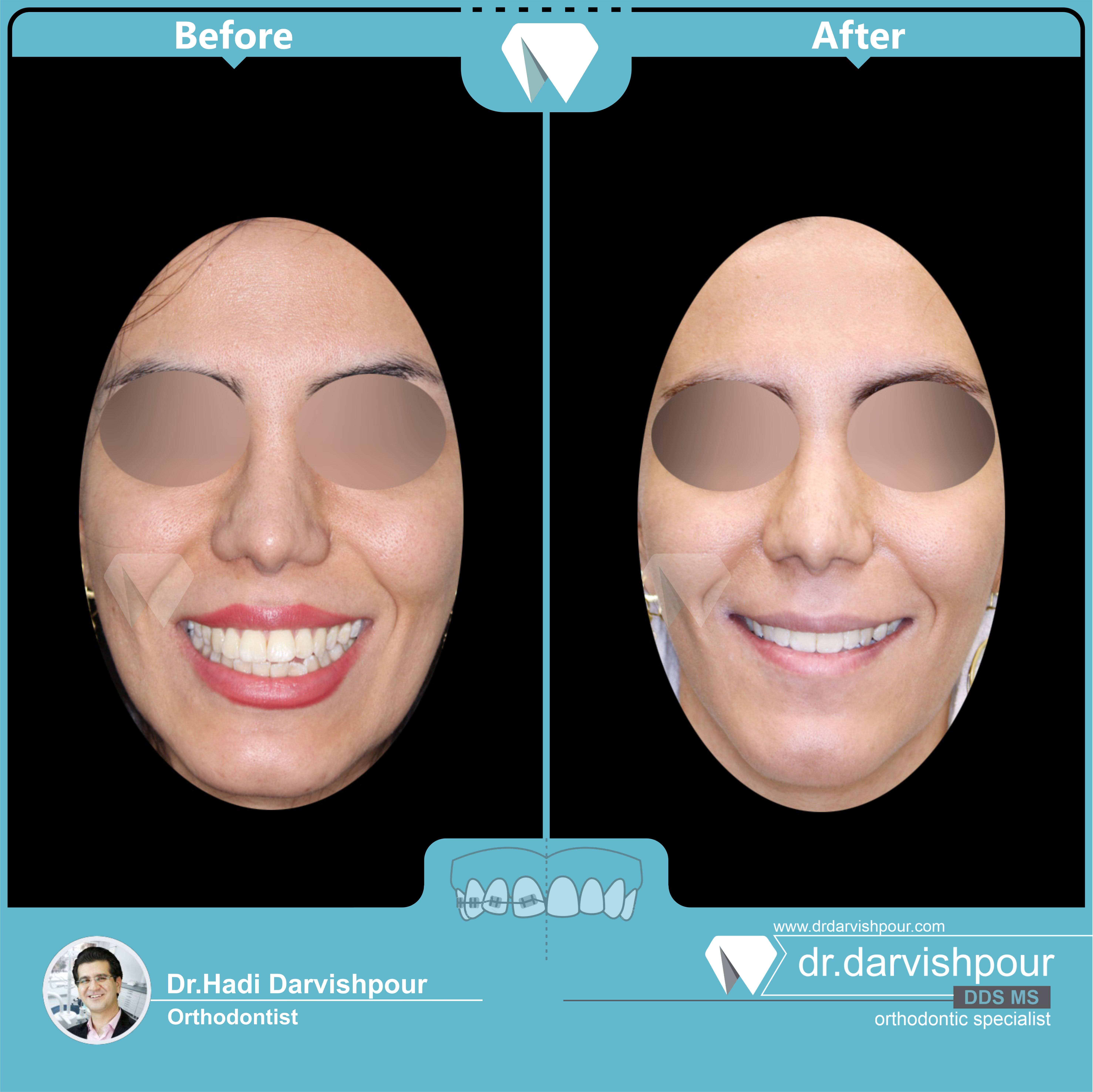 1739orthodontics-before-after-photo