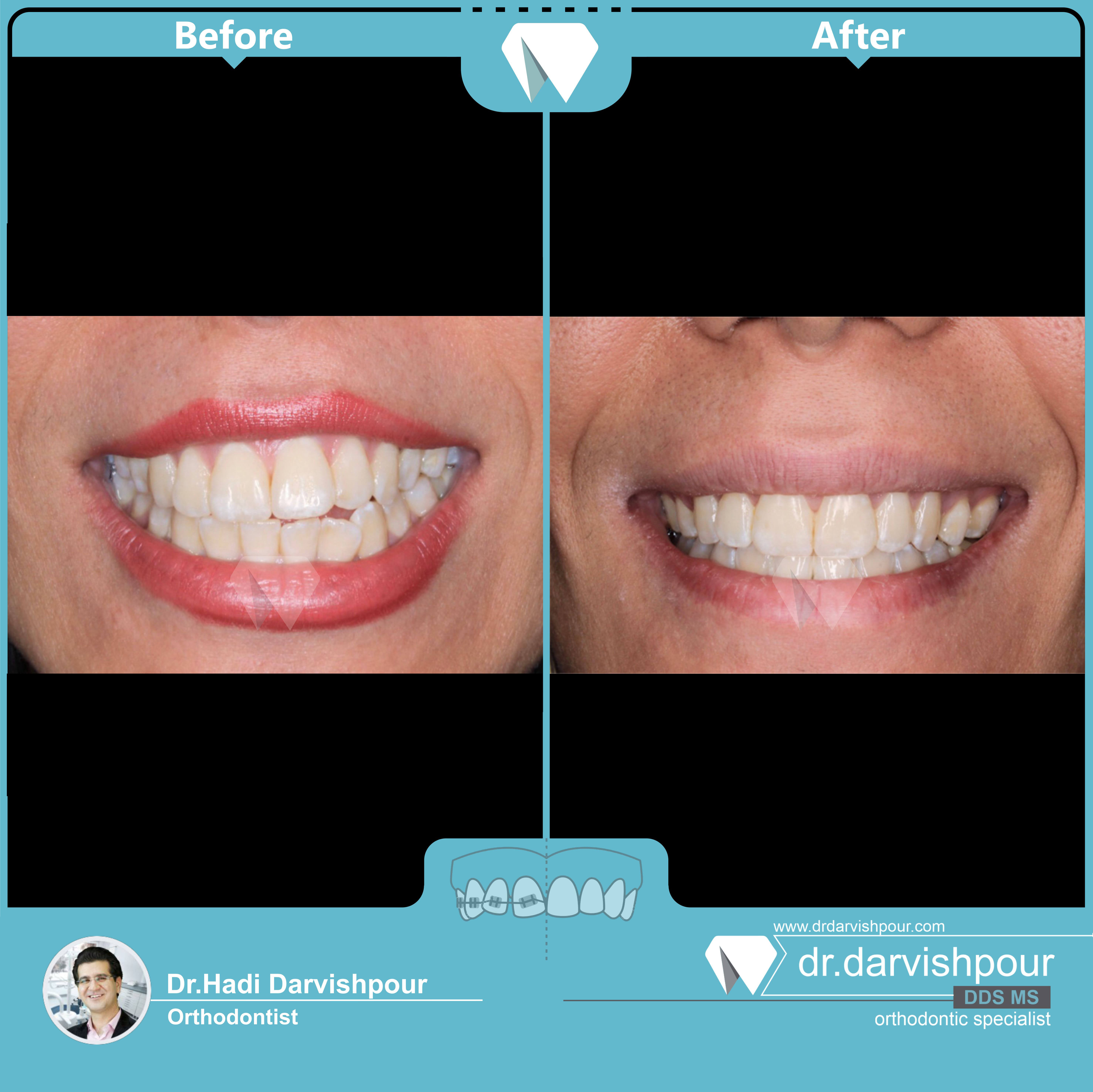 1740orthodontics-before-after-photo