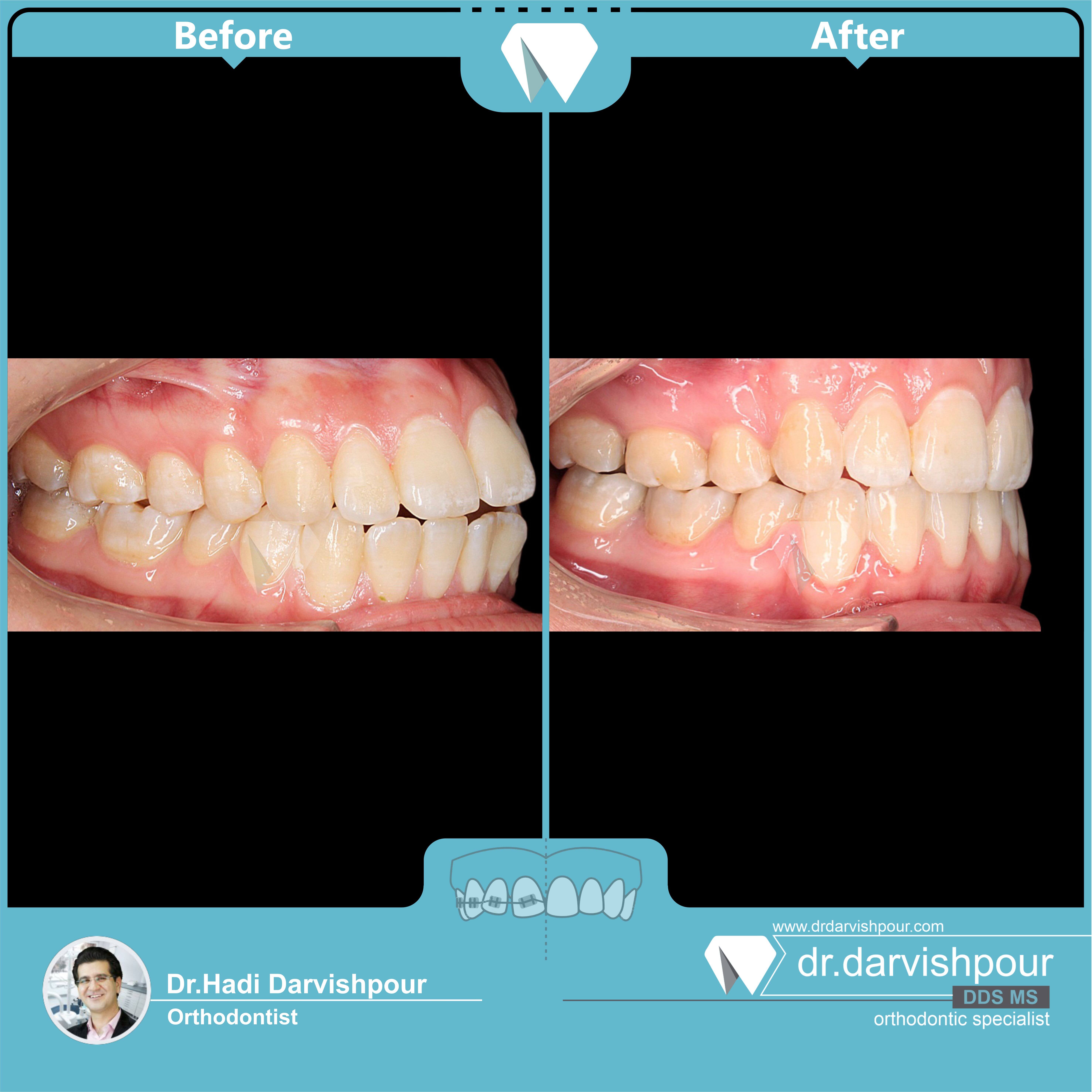 1741orthodontics-before-after-photo