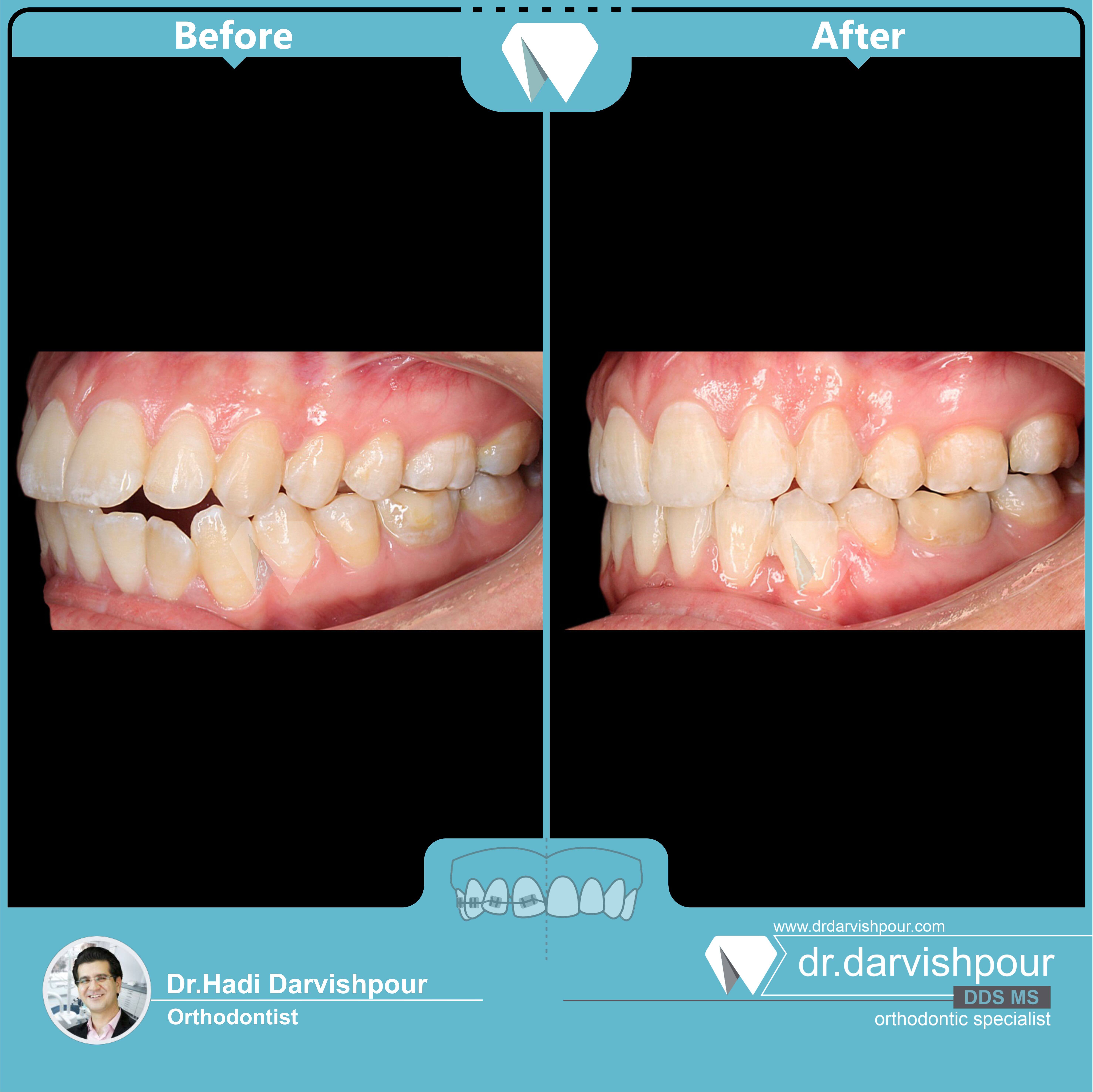 1742orthodontics-before-after-photo