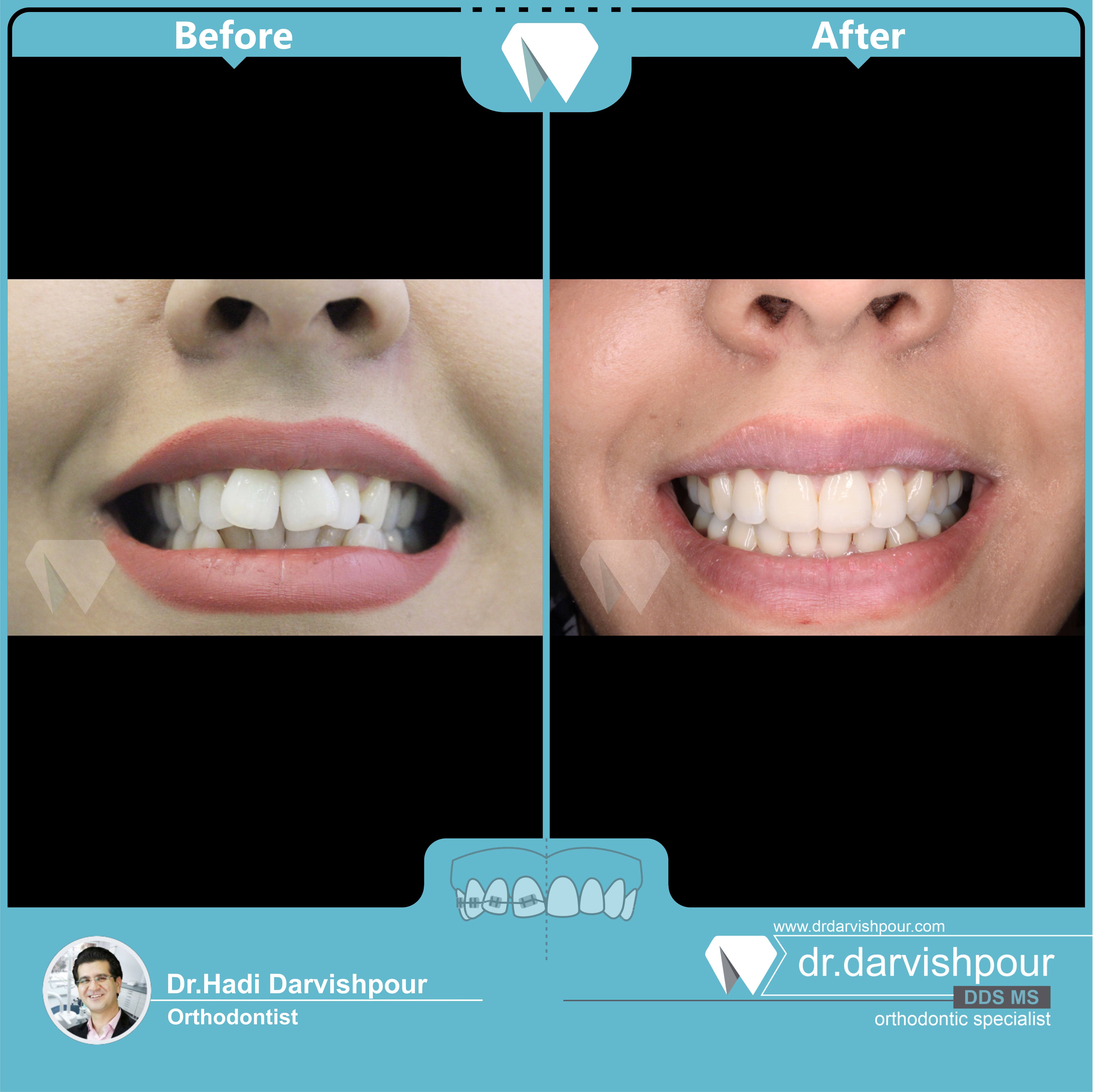 1745orthodontics-before-after-photo