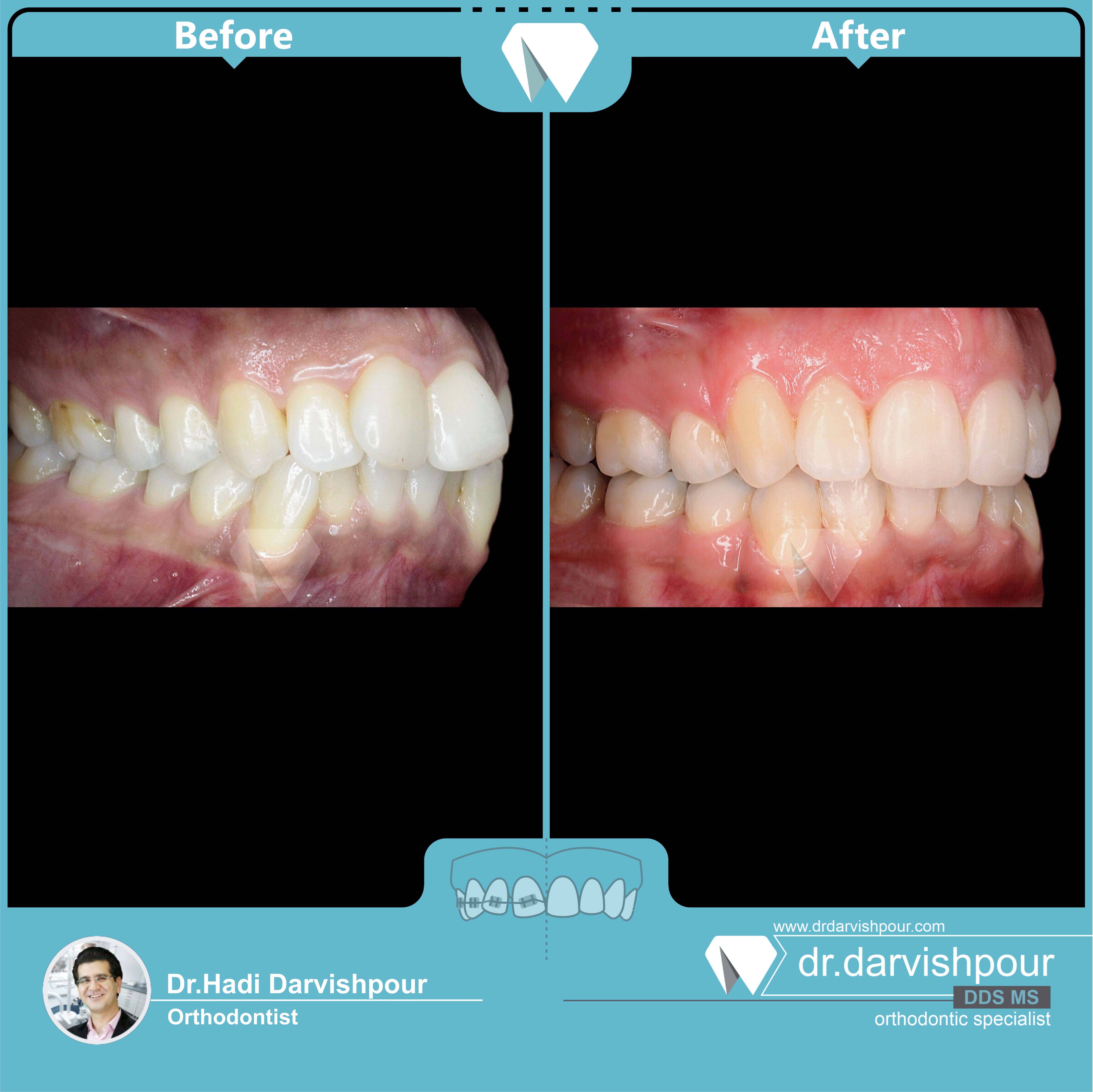 1746orthodontics-before-after-photo