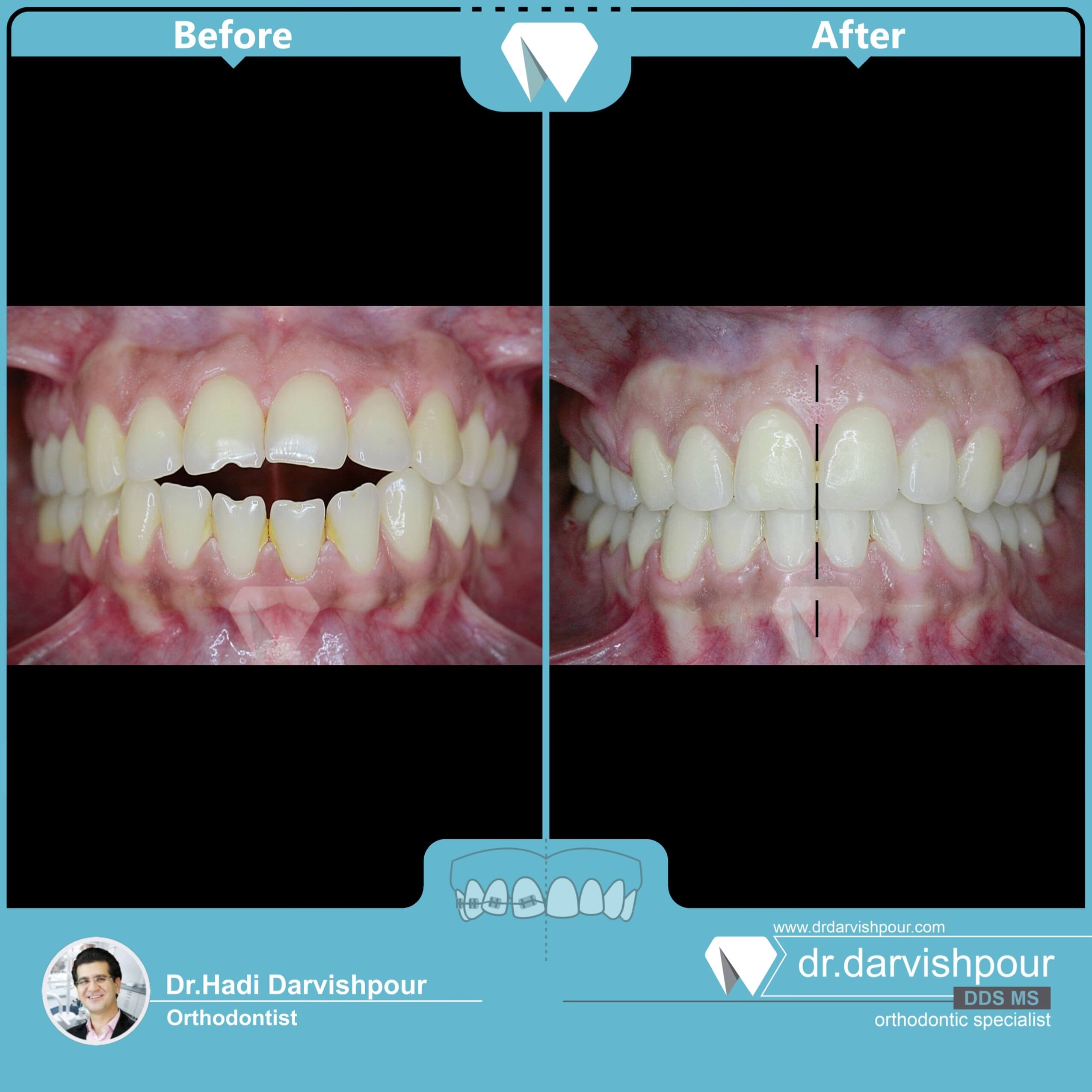 1748orthodontics-before-after-photo
