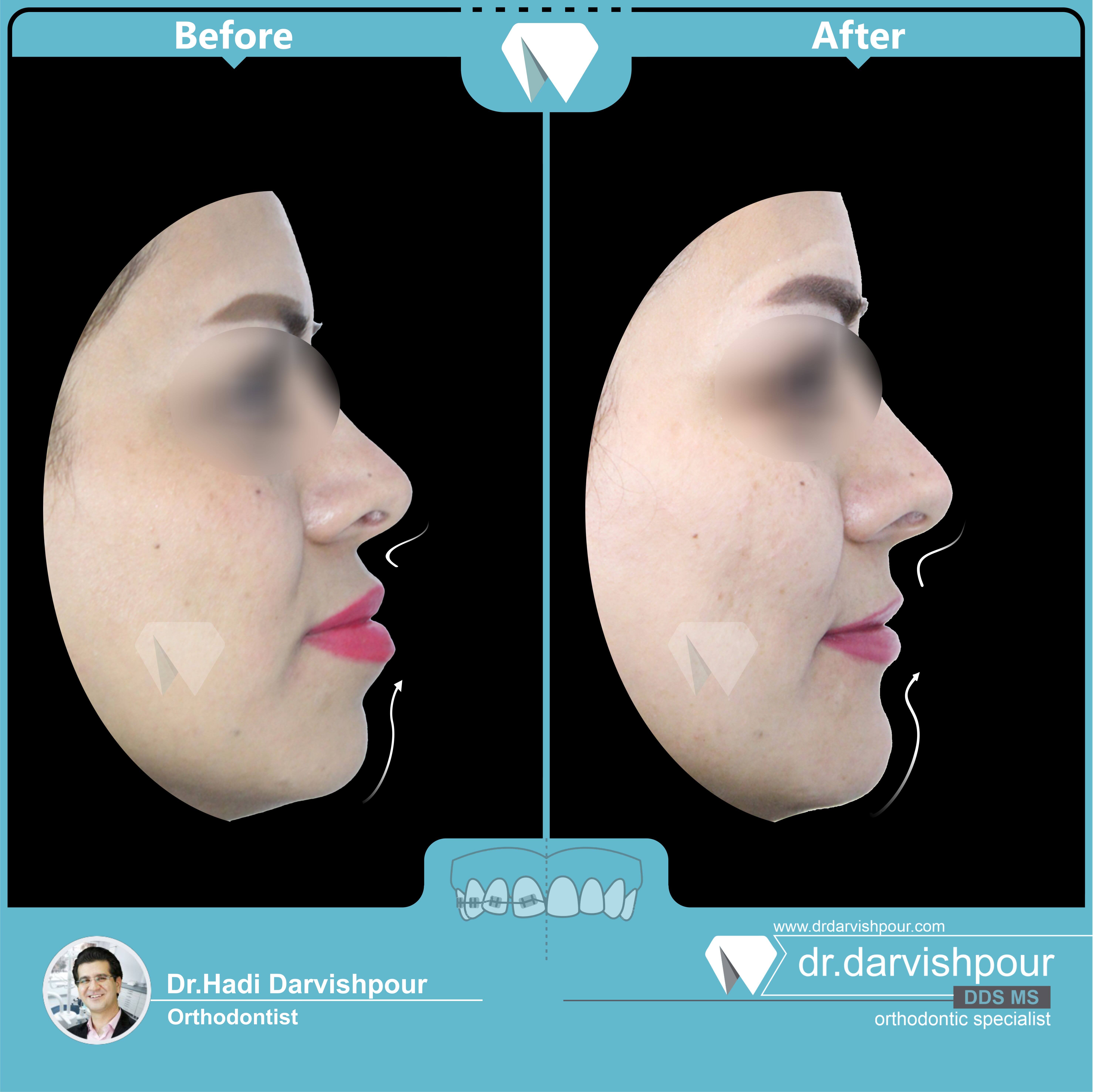 1749orthodontics-before-after-photo