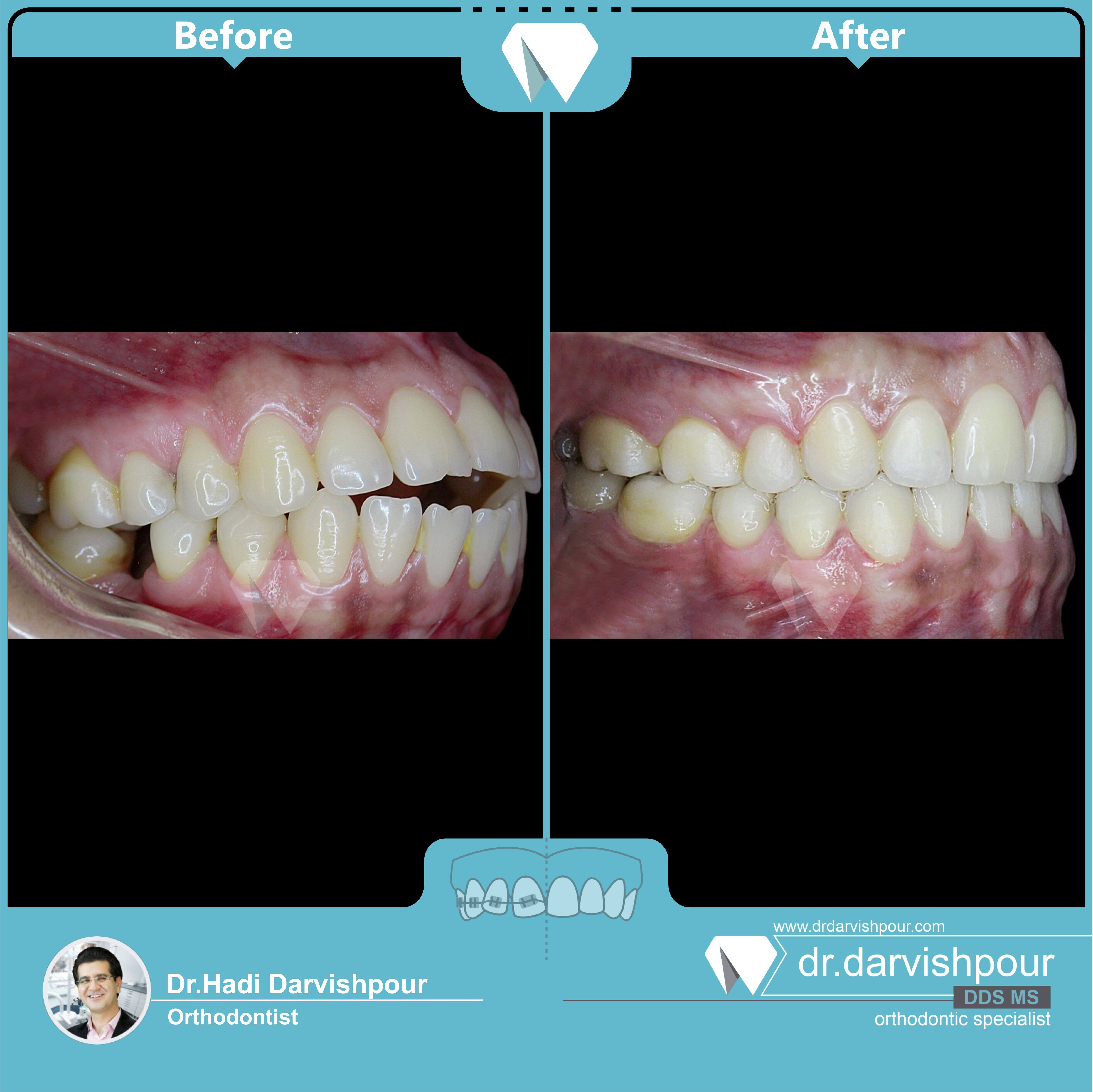 1750orthodontics-before-after-photo