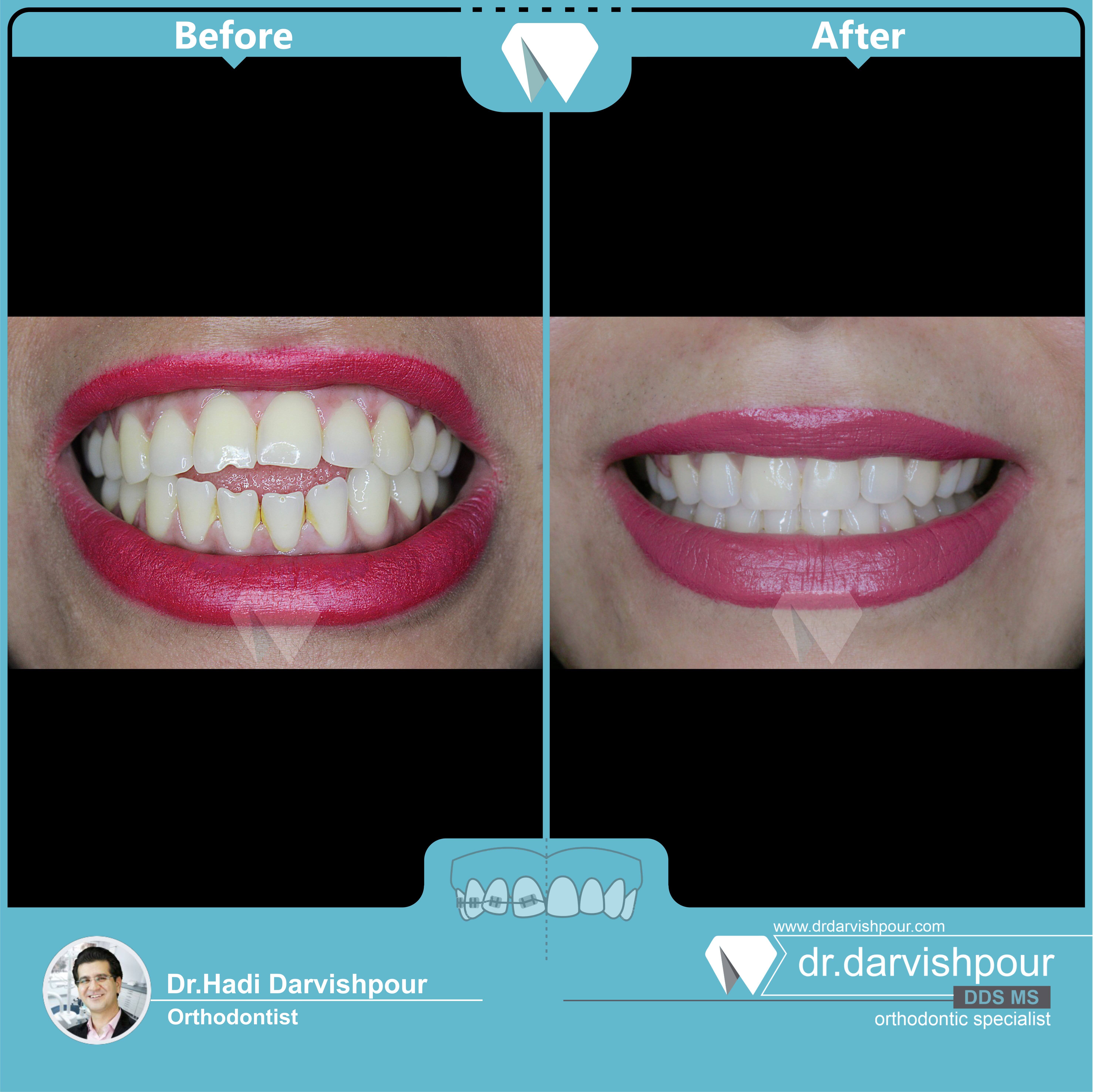 1751orthodontics-before-after-photo